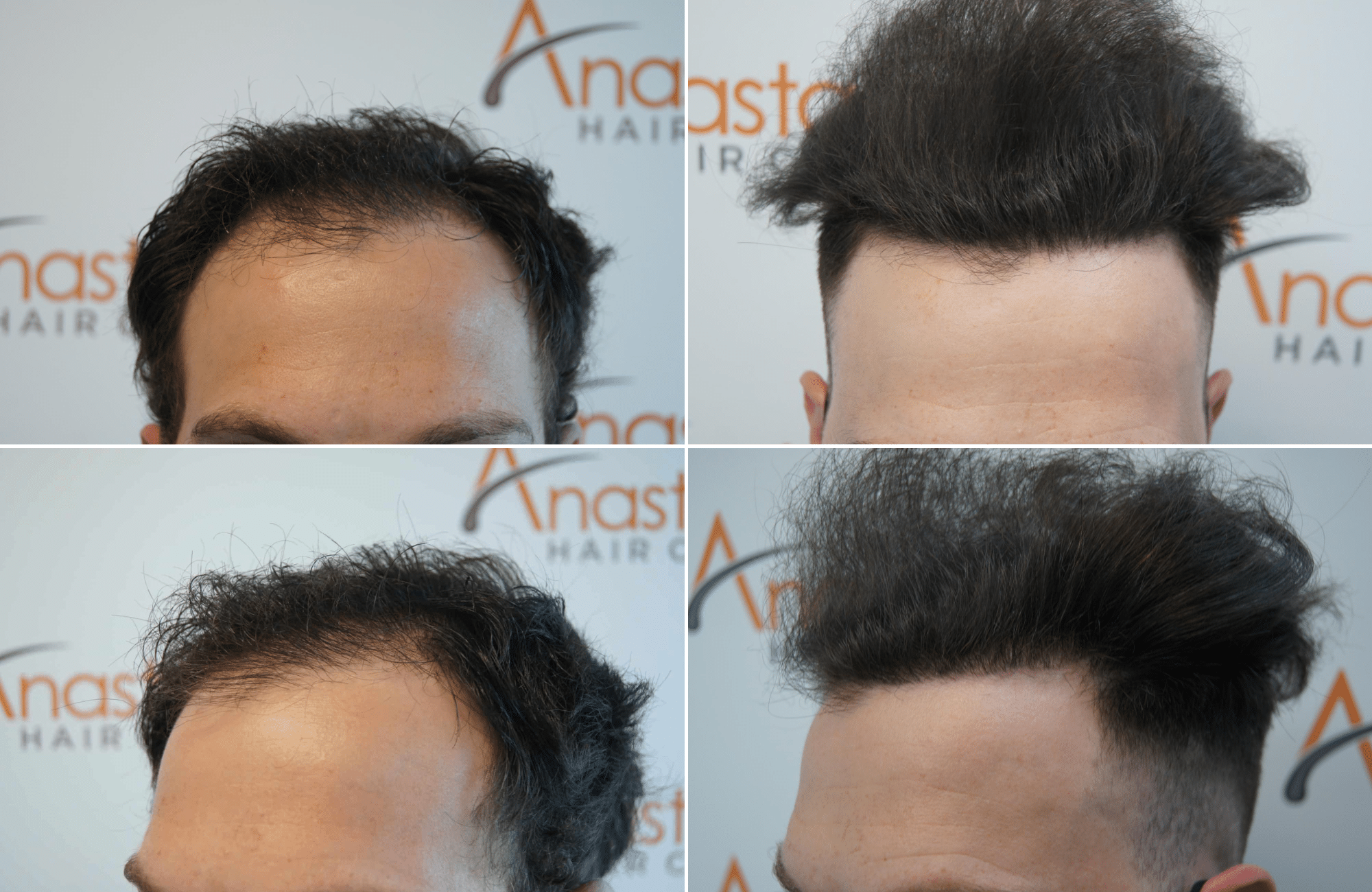 https://www.anastasakishairclinic.gr/portfolio/apotelesma-metamosxefsis-mallion-anastasakis-hair-clinic-265/