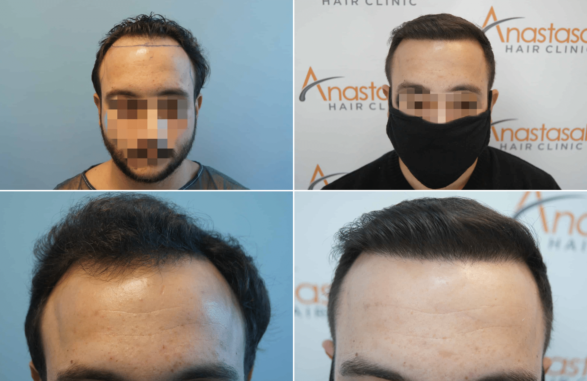 https://www.anastasakishairclinic.gr/portfolio/apotelesma-metamosxefsis-mallion-anastasakis-hair-clinic-27/