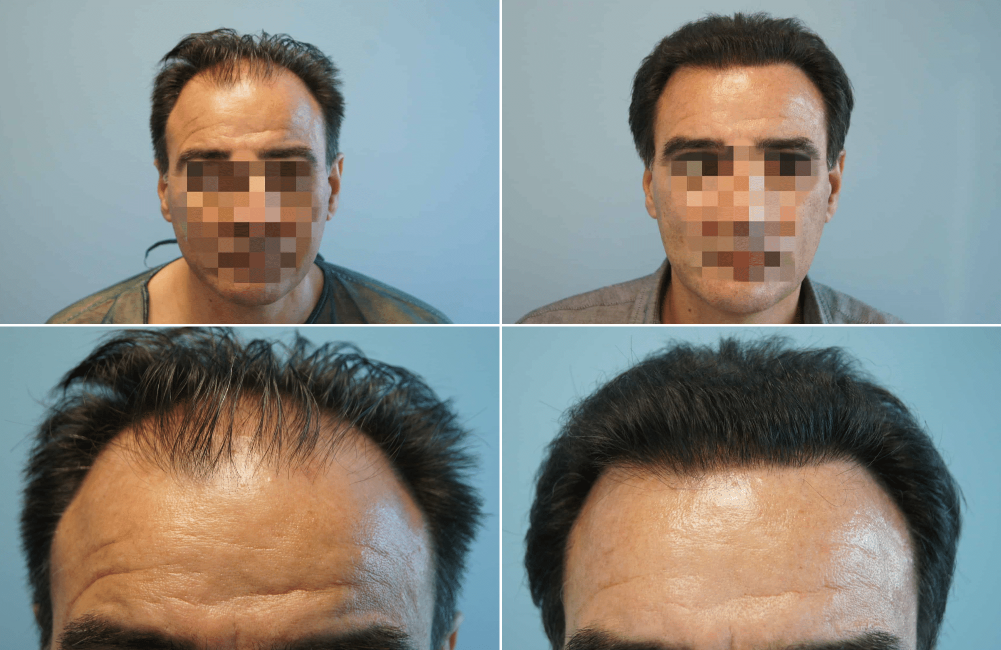 https://www.anastasakishairclinic.gr/portfolio/apotelesma-metamosxefsis-mallion-anastasakis-hair-clinic-28/
