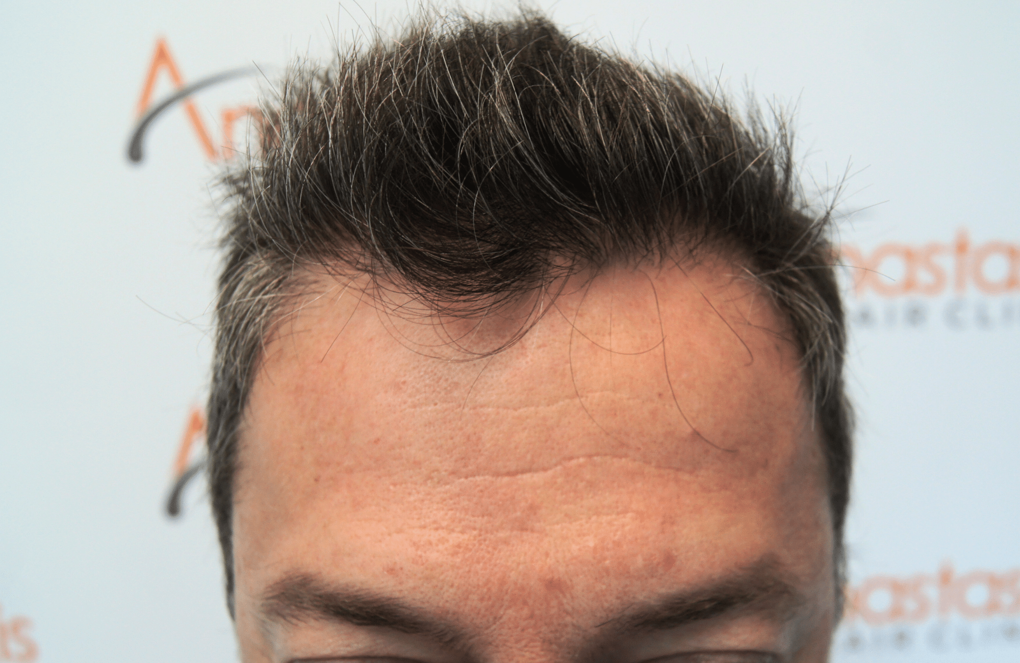 hair transplant result