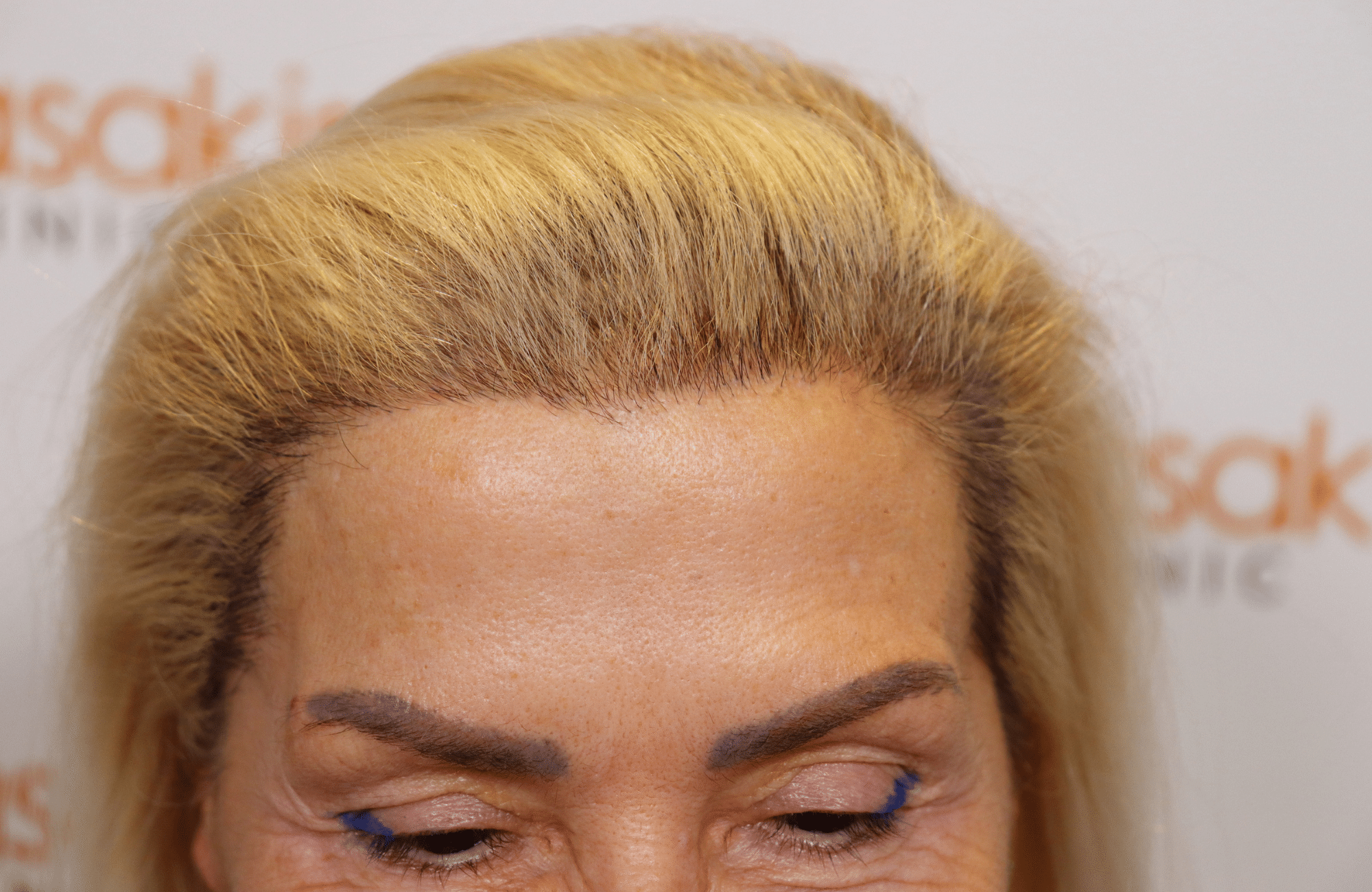 hair transplant result