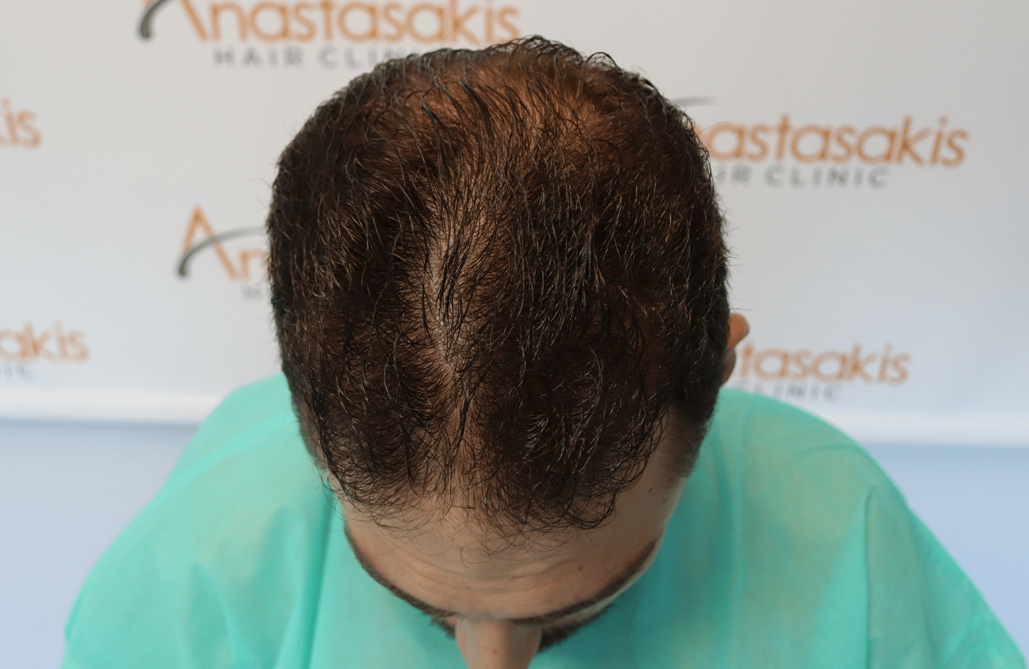 hair transplant result
