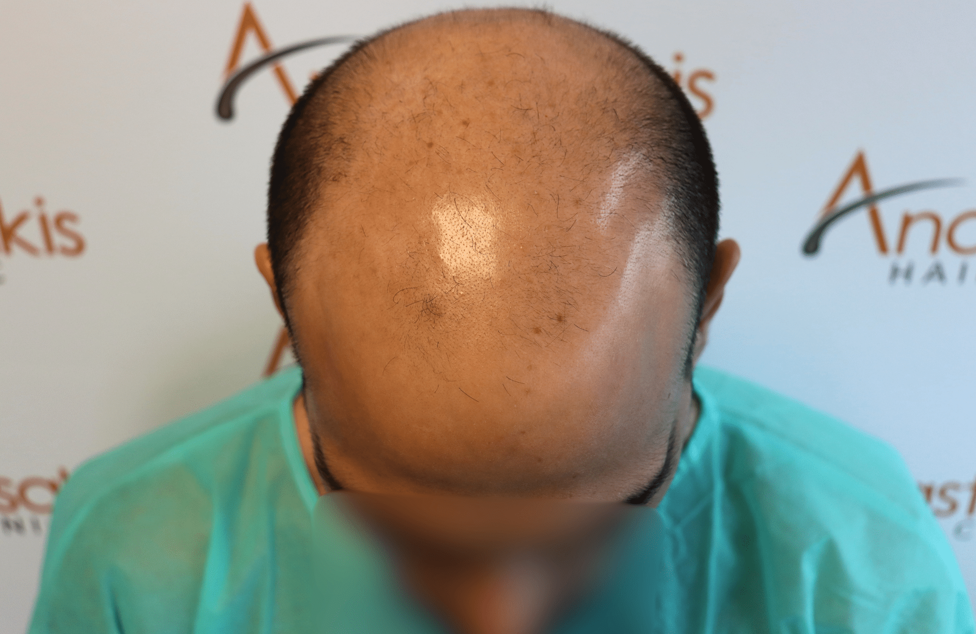 hai transplant result 3500 fus
