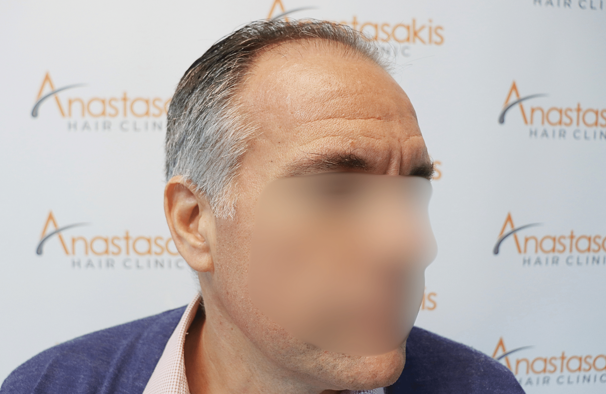 hair transplant result 2600