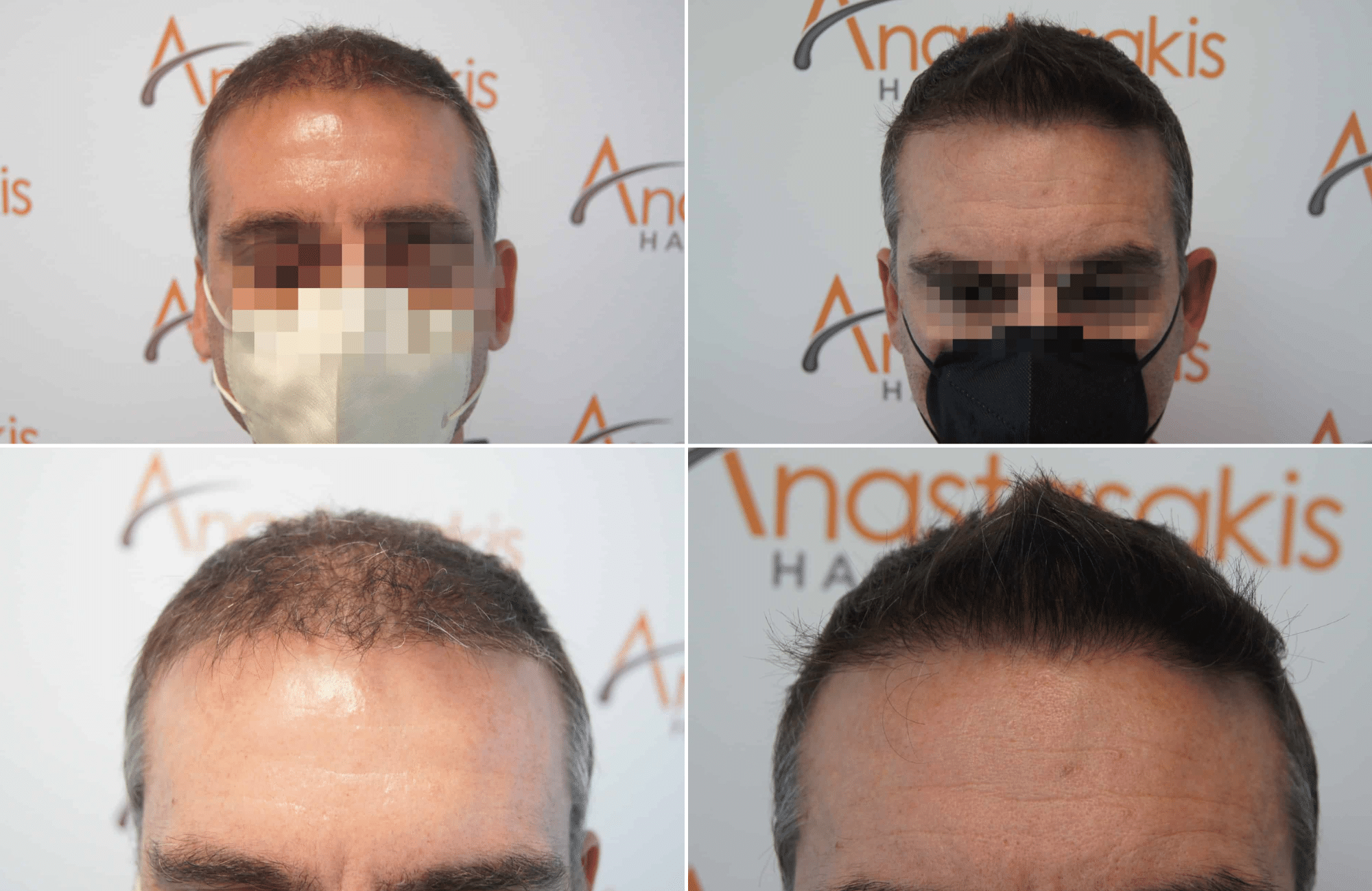 https://www.anastasakishairclinic.gr/portfolio/apotelesma-metamosxefsis-mallion-anastasakis-hair-clinic-302/