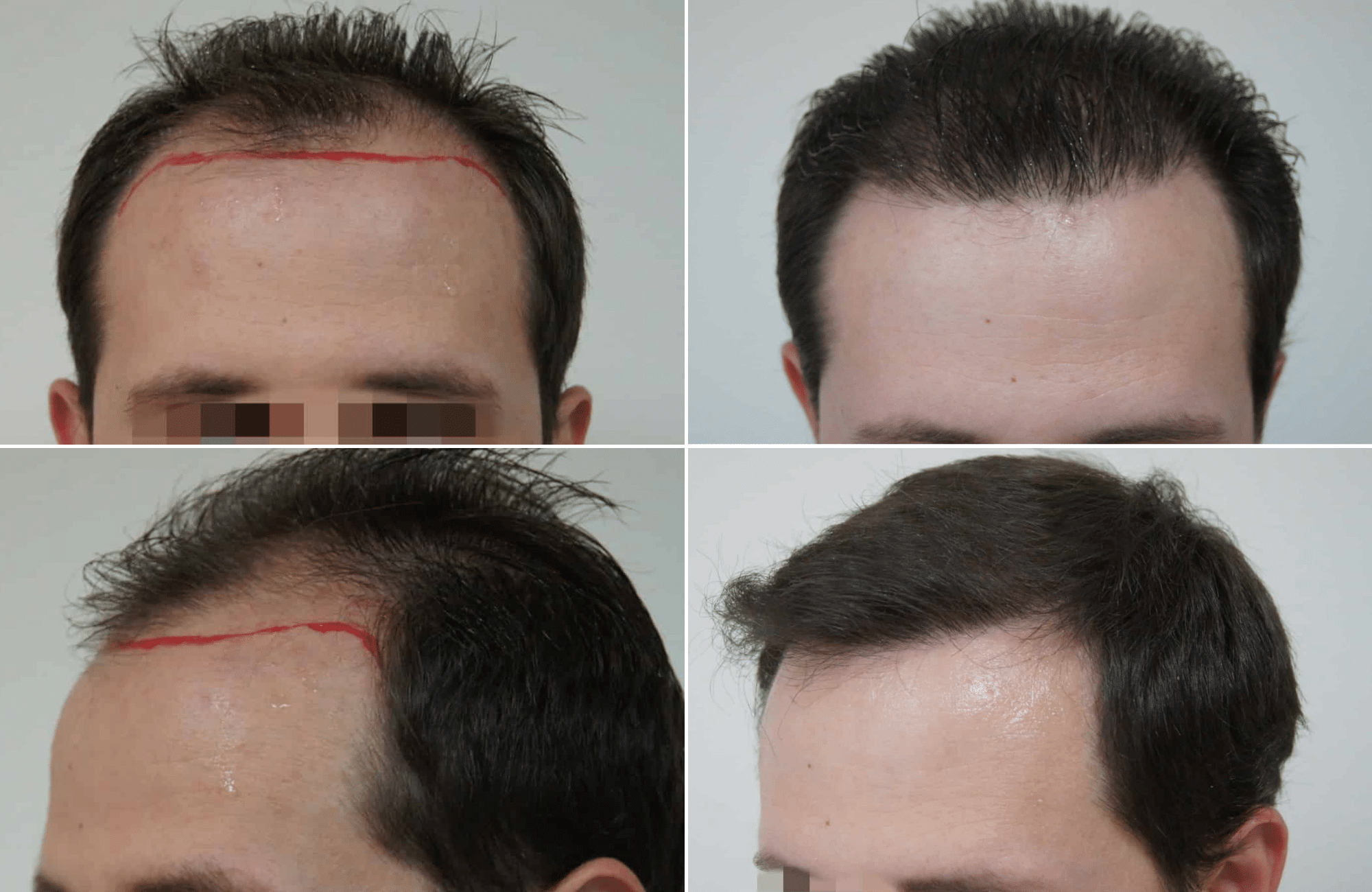 https://www.anastasakishairclinic.gr/portfolio/apotelesma-metamosxefsis-mallion-anastasakis-hair-clinic-38/
