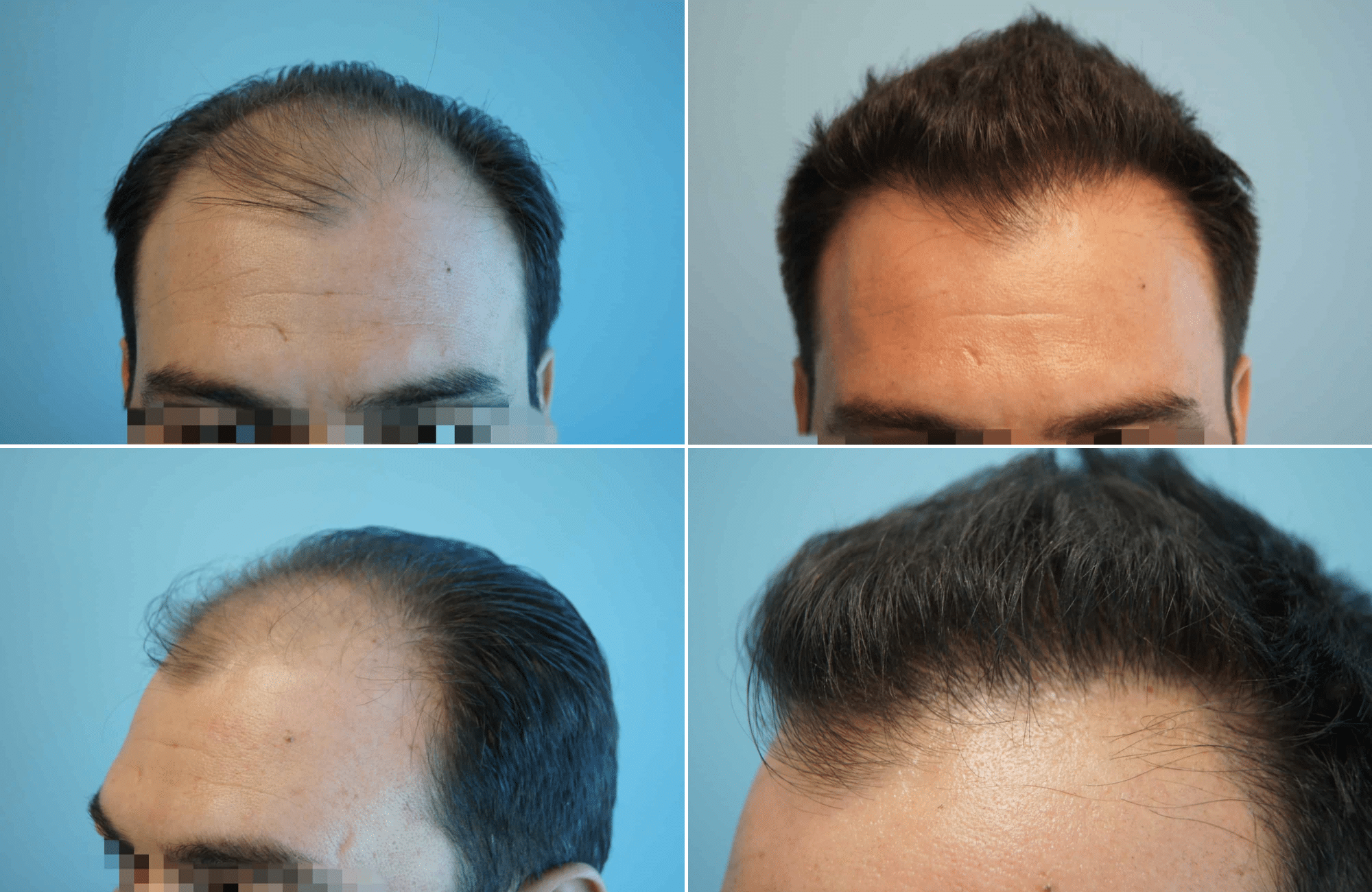 https://www.anastasakishairclinic.gr/portfolio/apotelesma-metamosxefsis-mallion-anastasakis-hair-clinic-39/
