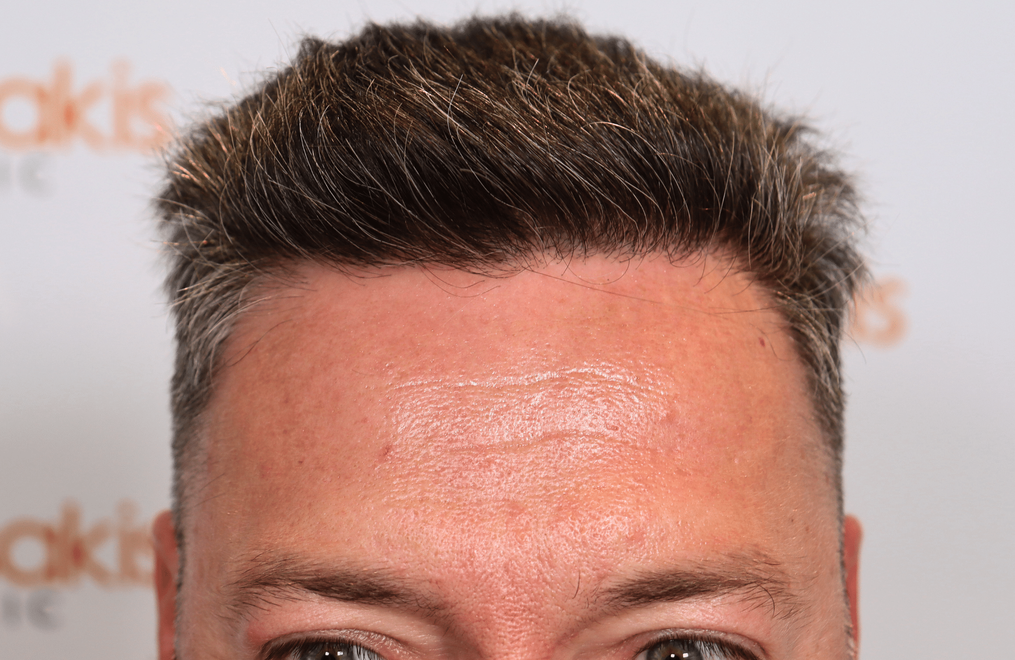 hair transplant result