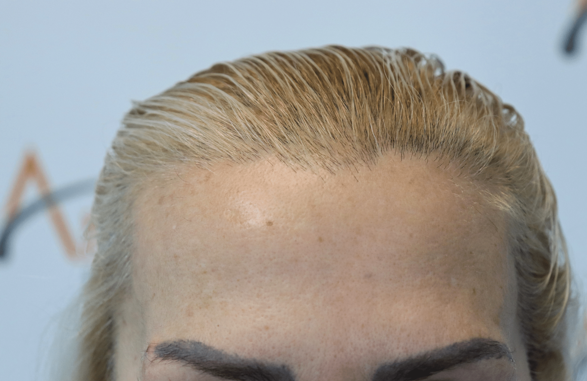 hair transplant result