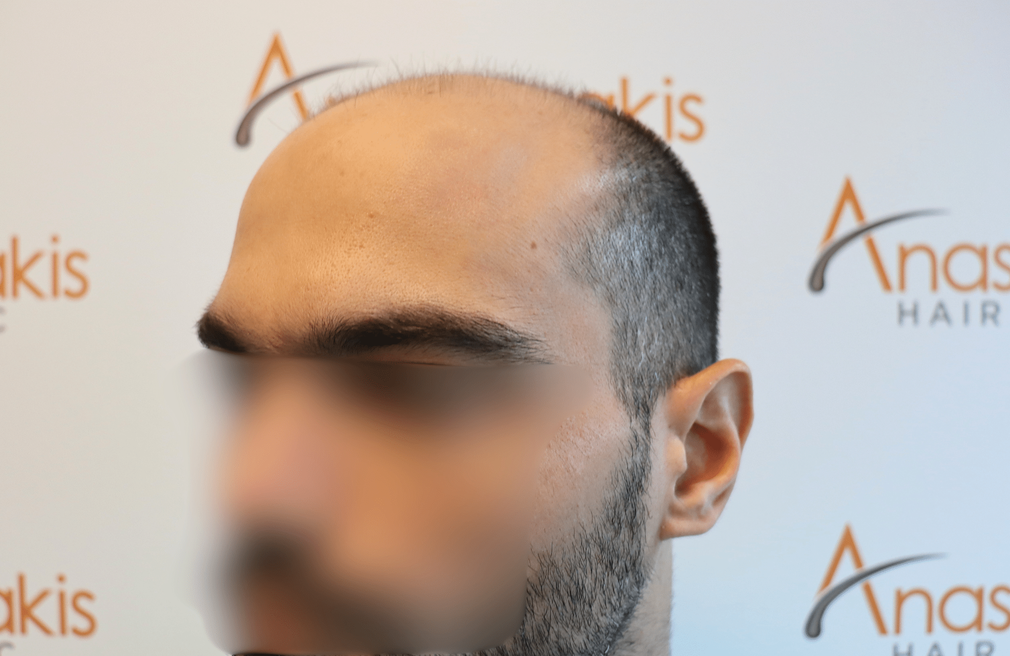 hai transplant result 3500 fus