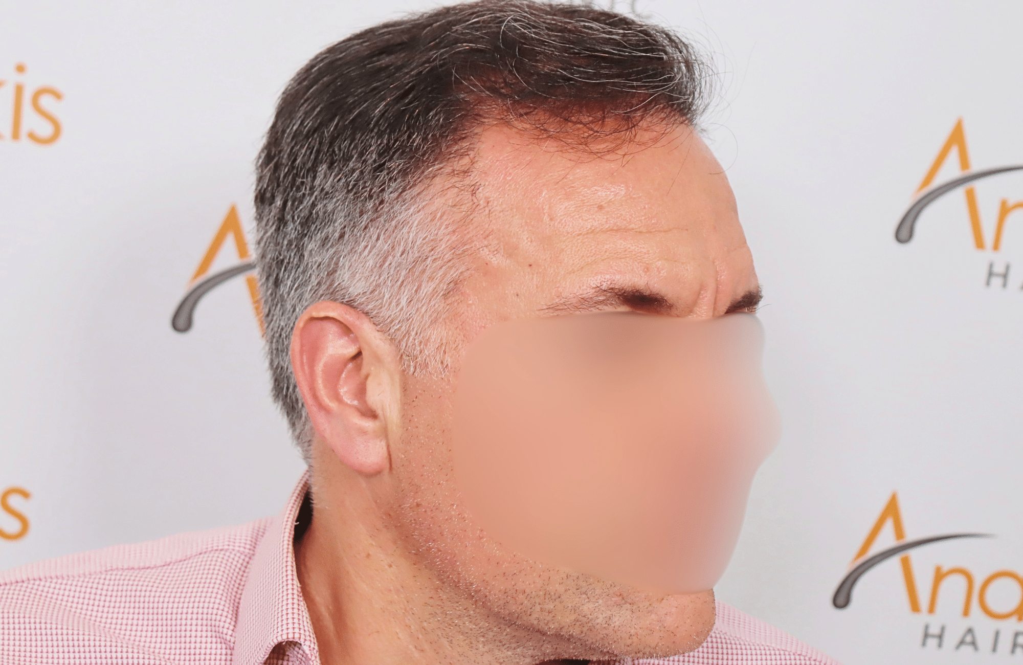 hair transplant result 2600