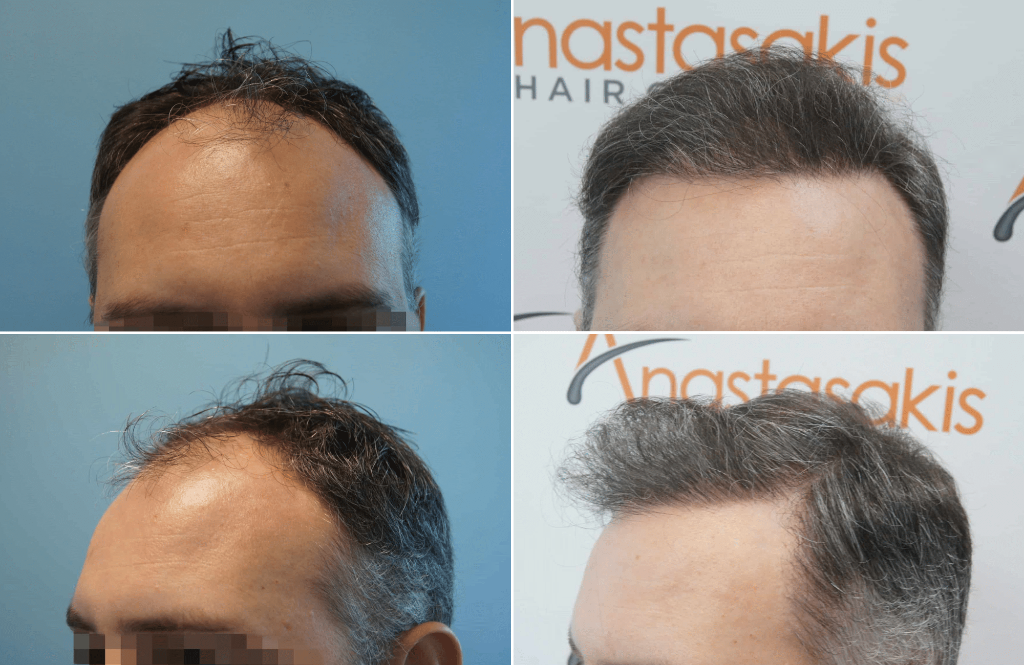https://www.anastasakishairclinic.gr/portfolio/apotelesma-metamosxefsis-mallion-anastasakis-hair-clinic-40/