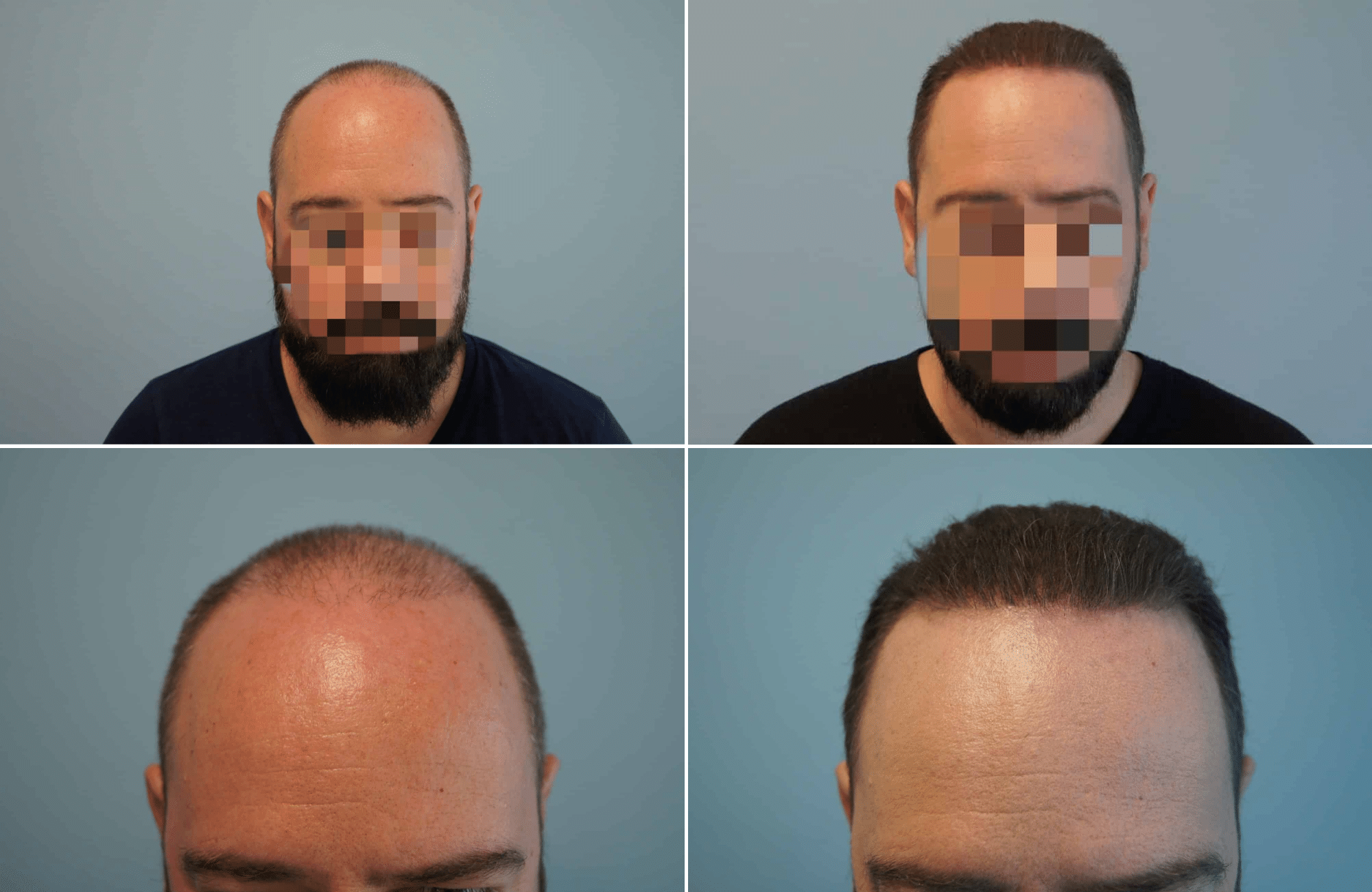 https://www.anastasakishairclinic.gr/portfolio/apotelesma-metamosxefsis-mallion-anastasakis-hair-clinic-41/