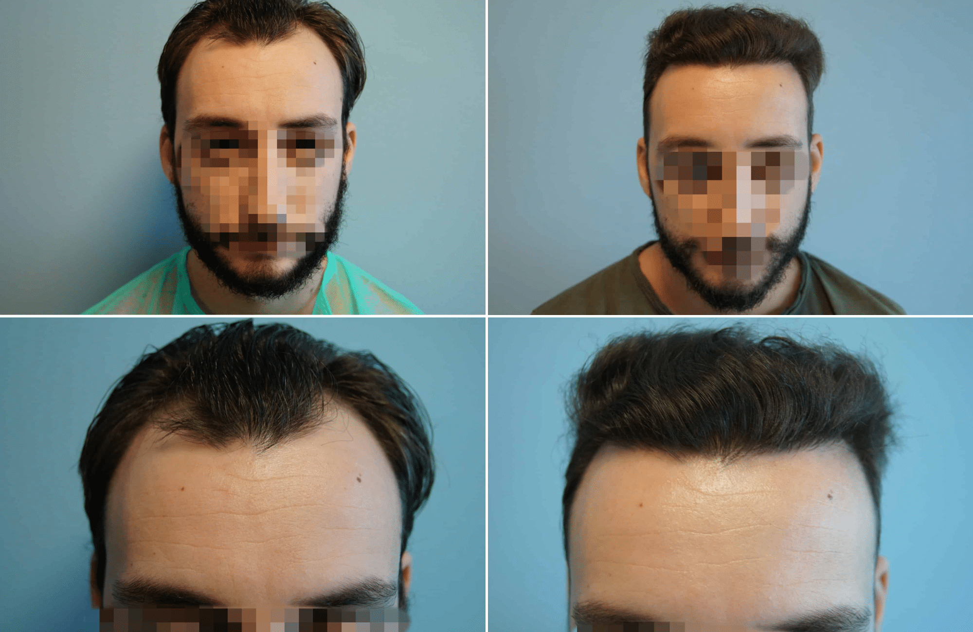 https://www.anastasakishairclinic.gr/portfolio/apotelesma-metamosxefsis-mallion-anastasakis-hair-clinic-45/