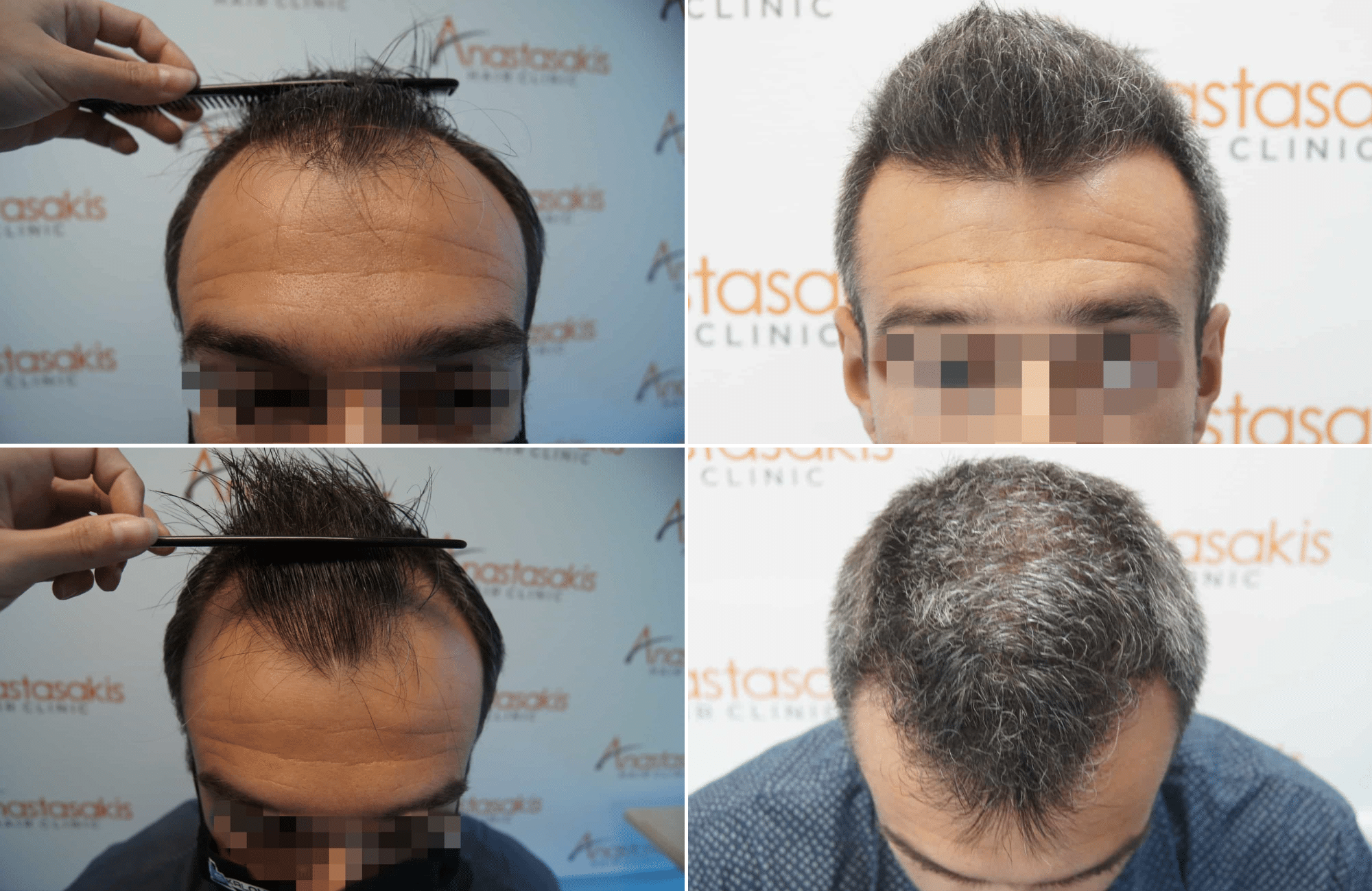 https://www.anastasakishairclinic.gr/portfolio/apotelesma-metamosxefsis-mallion-anastasakis-hair-clinic-49/