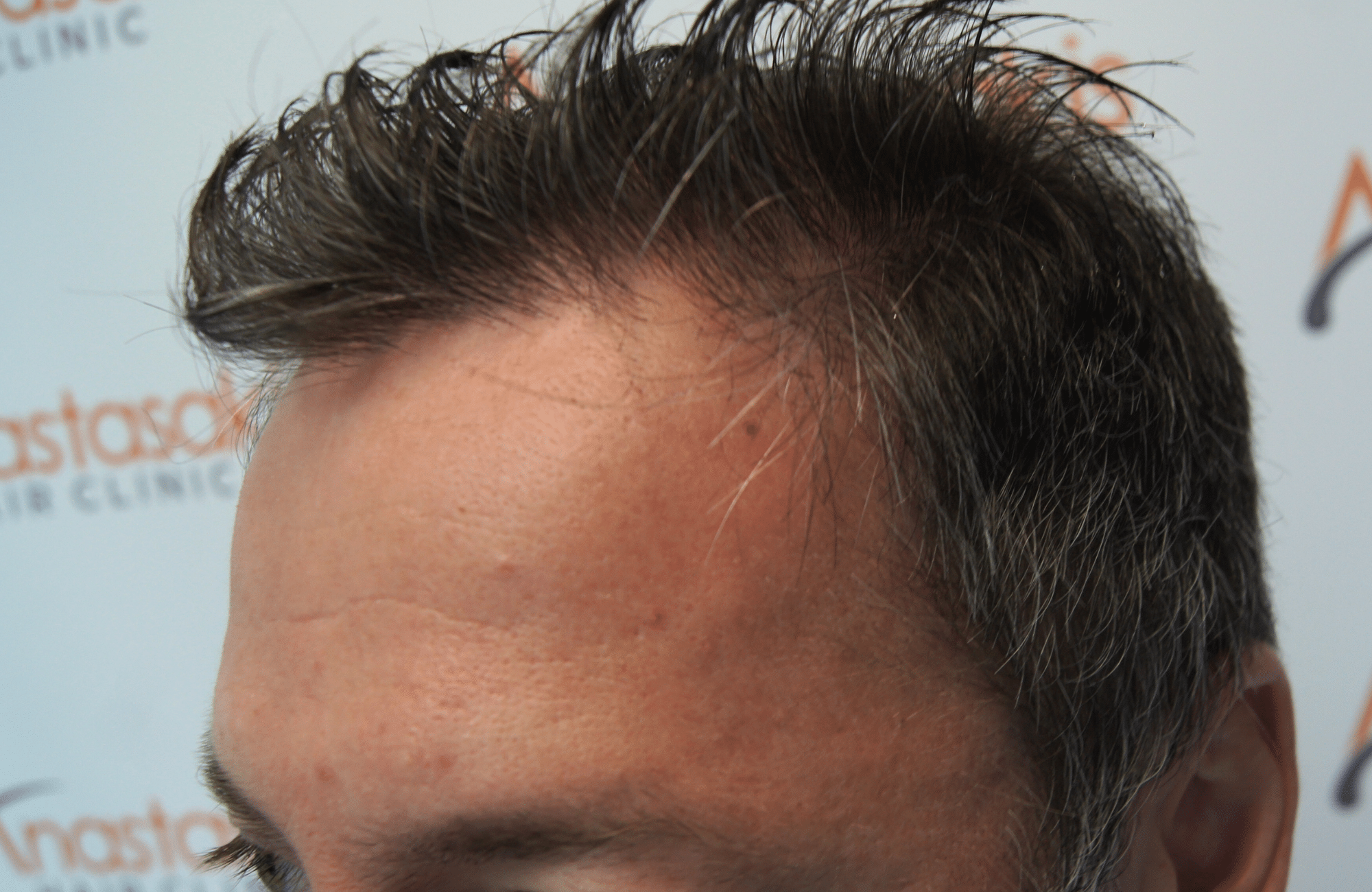 hair transplant result