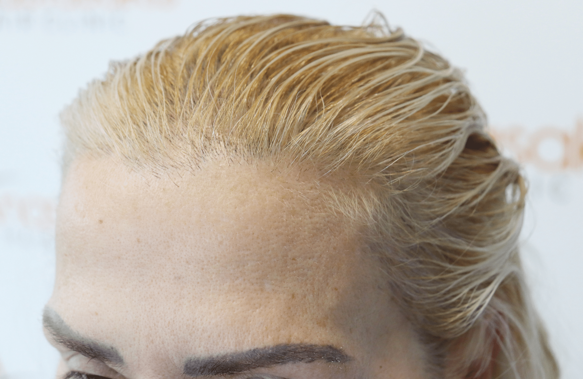 hair transplant result