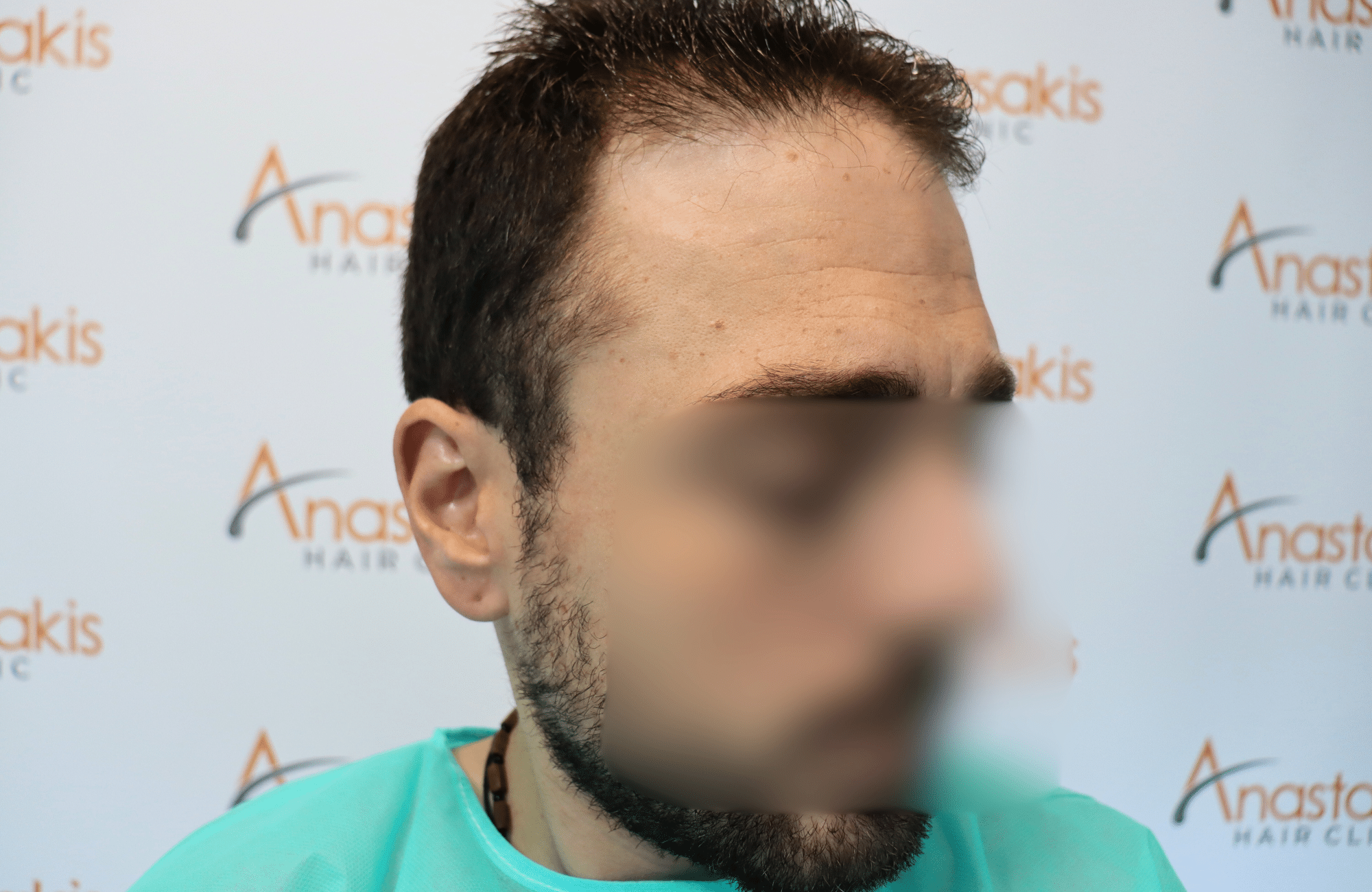 hair transplant result