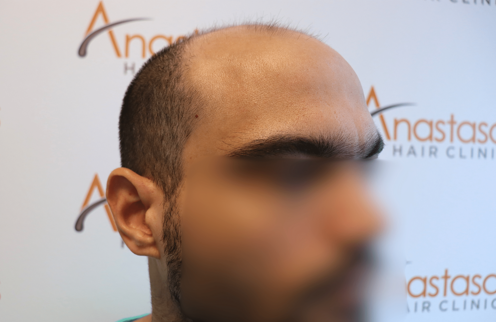 hai transplant result 3500 fus