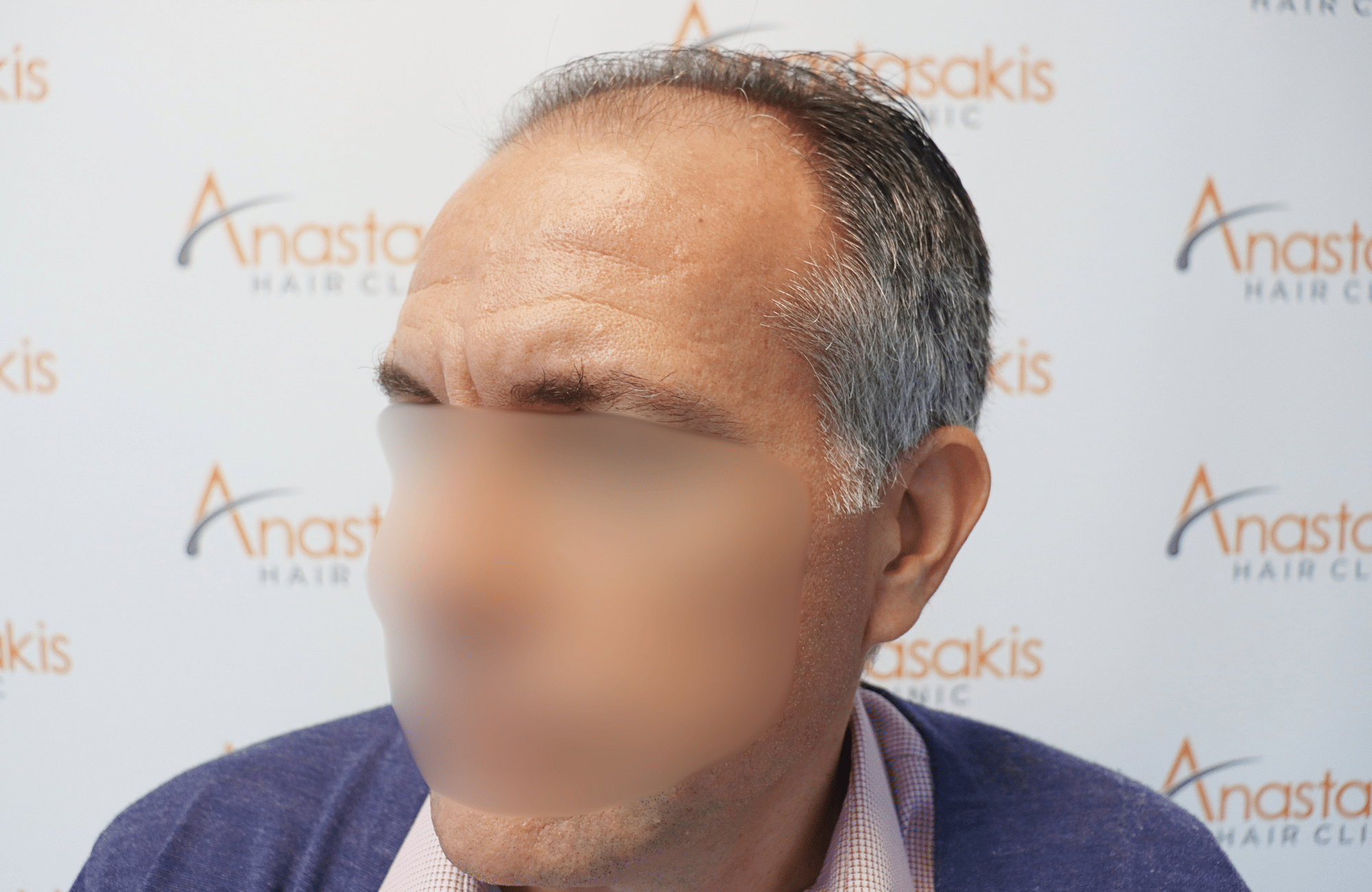 hair transplant result 2600