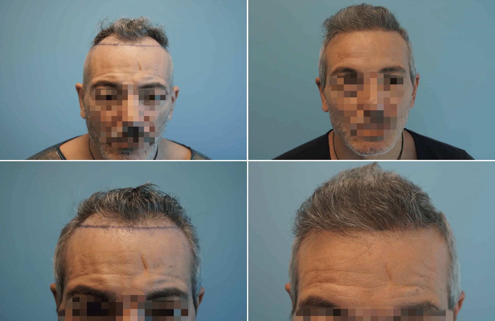https://www.anastasakishairclinic.gr/portfolio/apotelesma-metamosxefsis-mallion-anastasakis-hair-clinic-55/