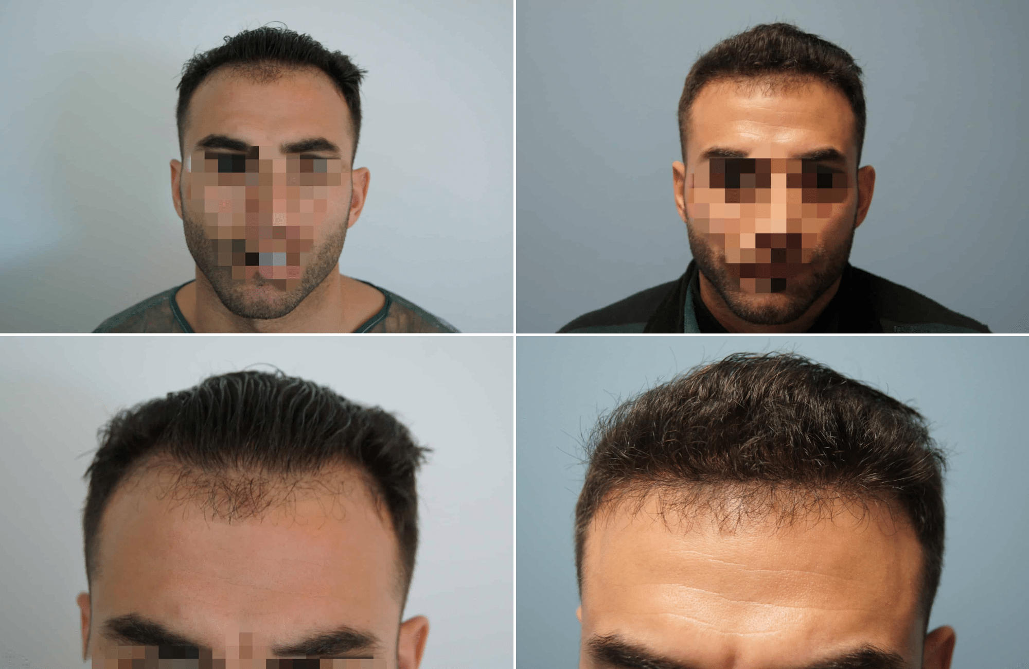 https://www.anastasakishairclinic.gr/portfolio/apotelesma-metamosxefsis-mallion-anastasakis-hair-clinic-57/