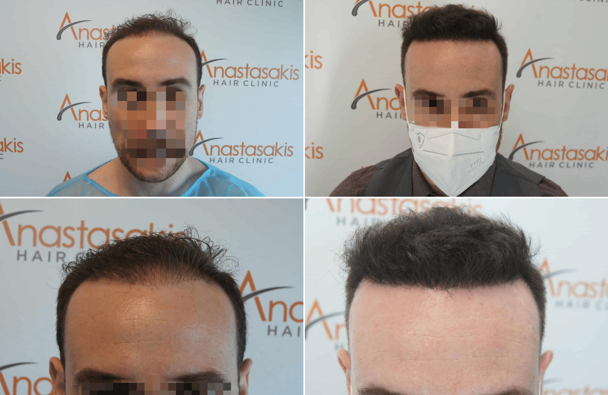 https://www.anastasakishairclinic.gr/portfolio/apotelesma-metamosxefsis-mallion-anastasakis-hair-clinic-58/