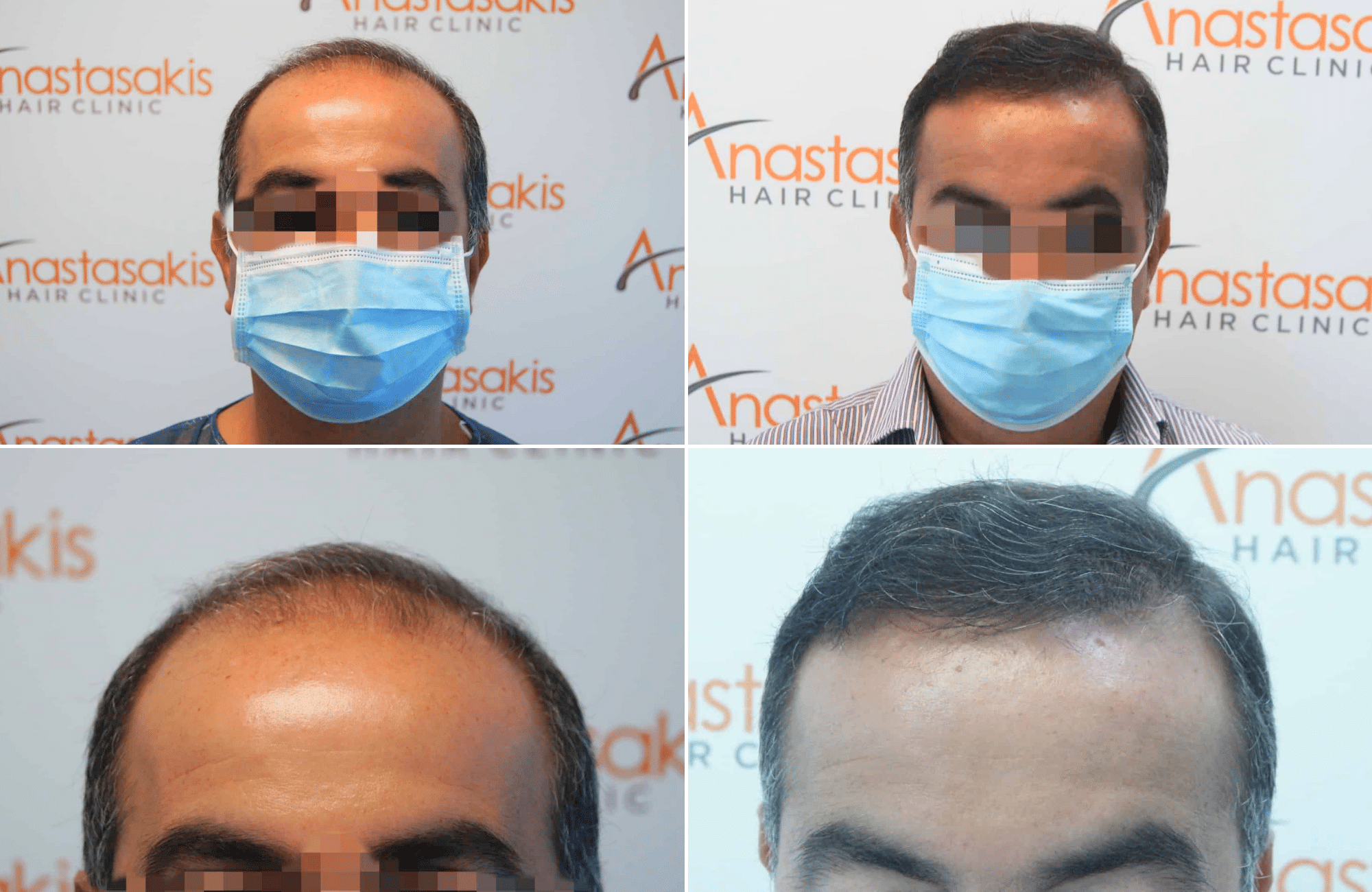 https://www.anastasakishairclinic.gr/portfolio/apotelesma-metamosxefsis-mallion-anastasakis-hair-clinic-59/