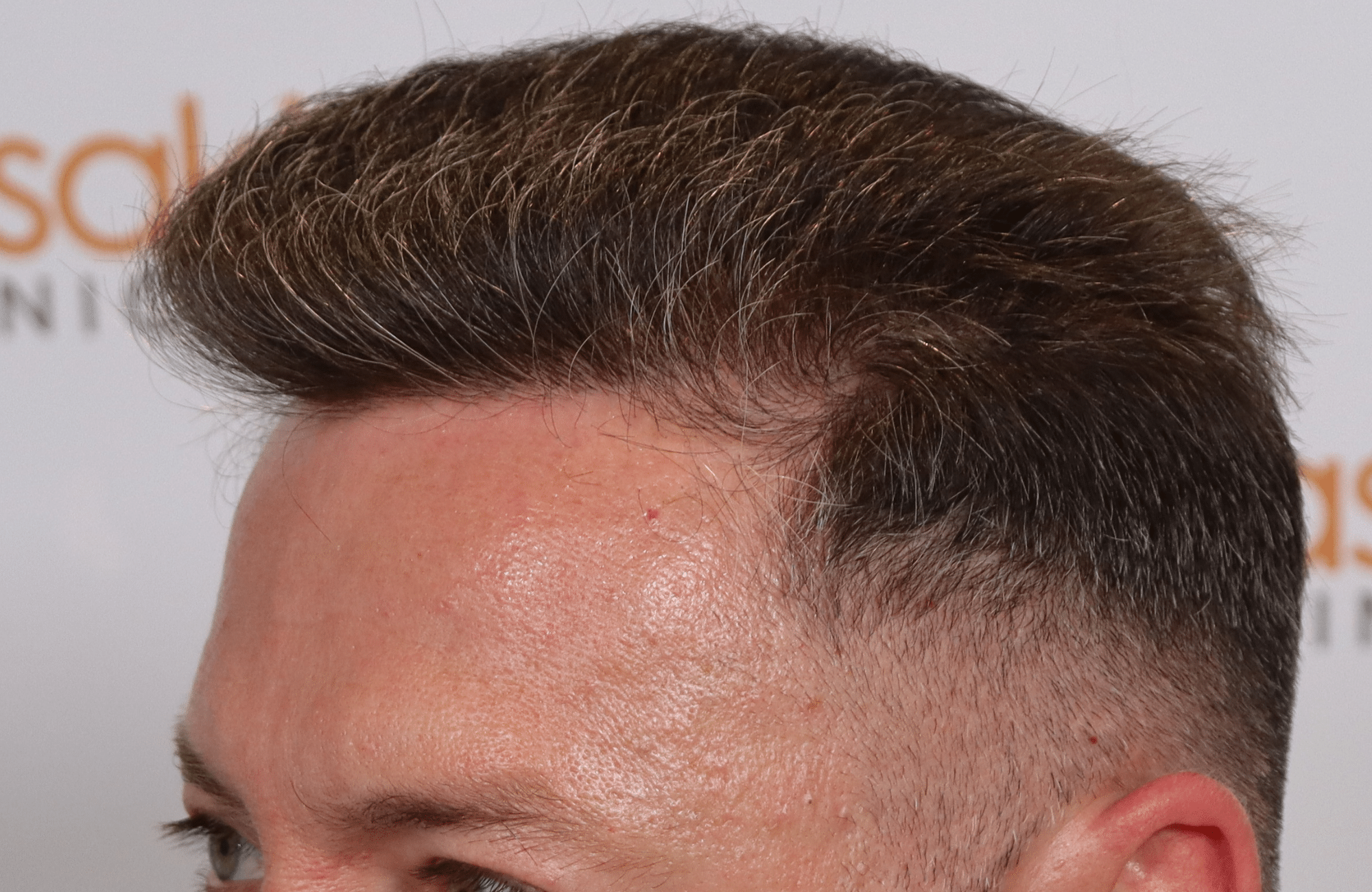hair transplant result