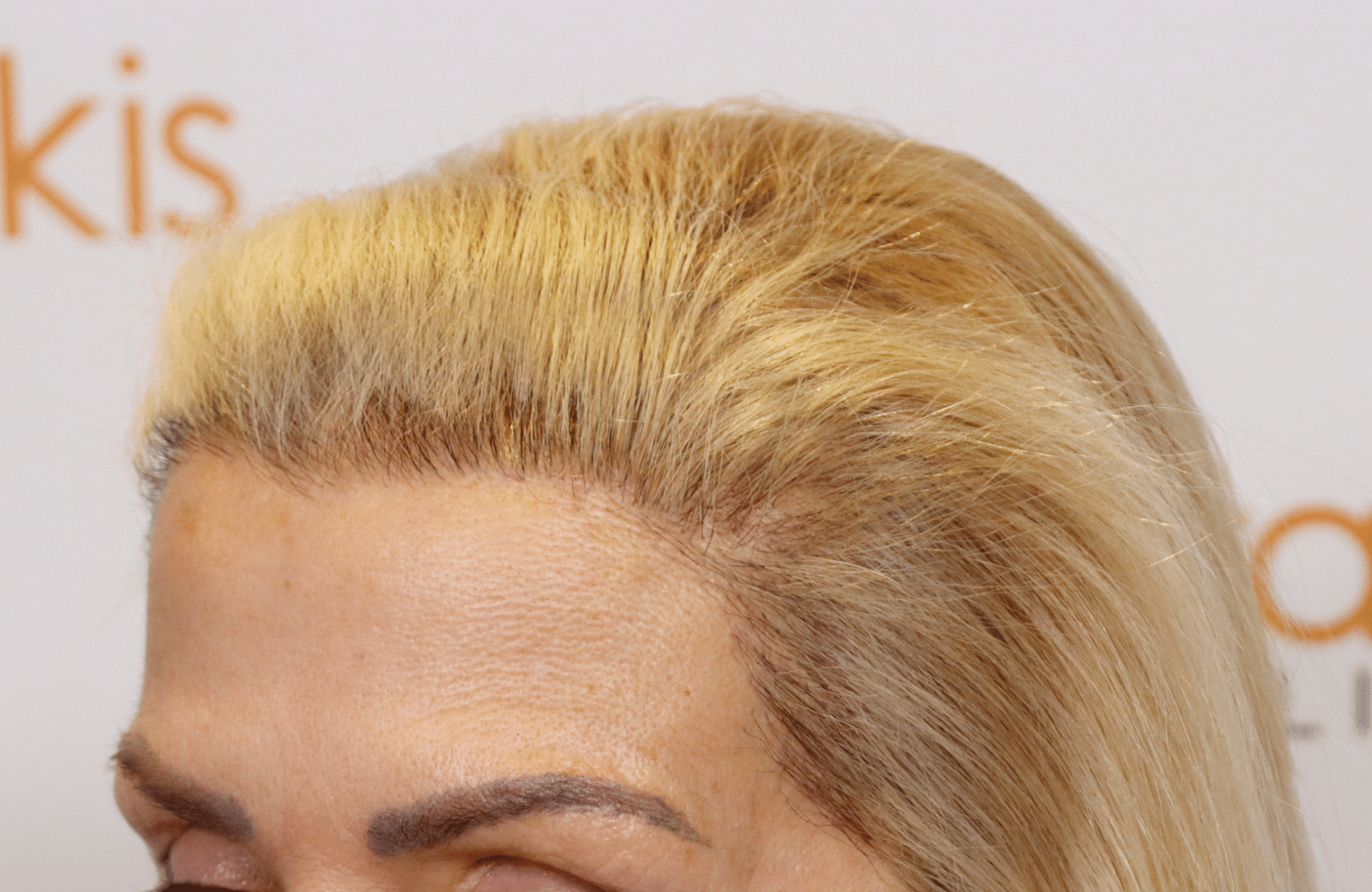 hair transplant result