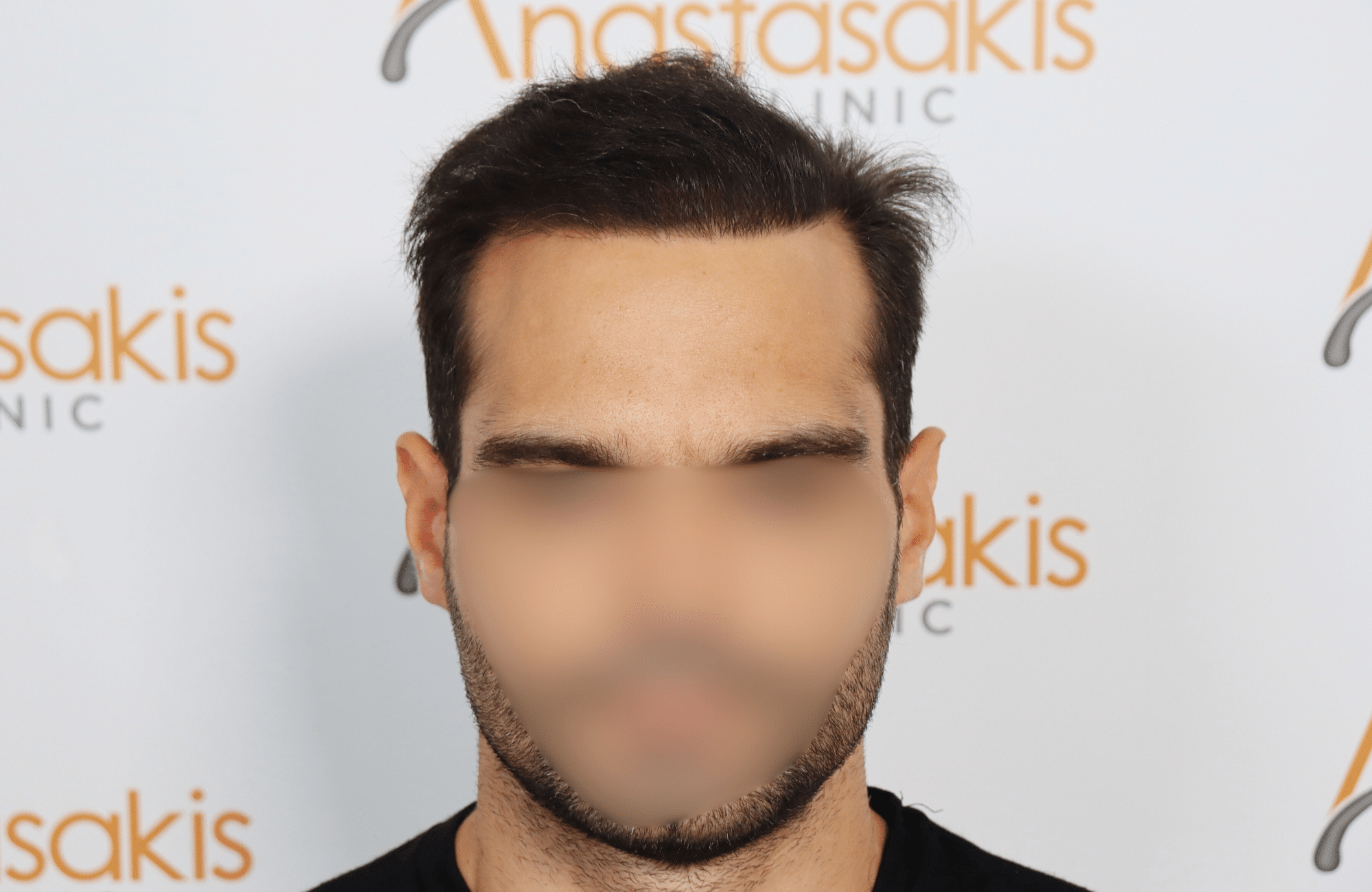 hai transplant result 3500 fus