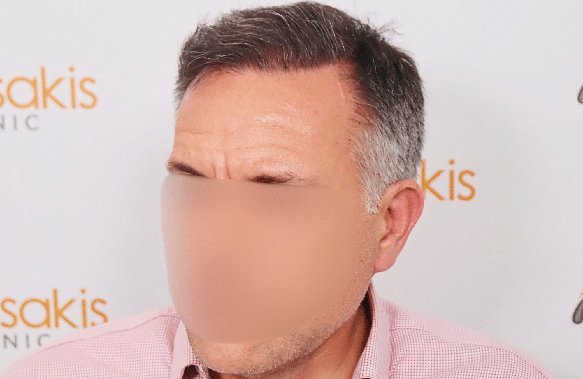 hair transplant result 2600