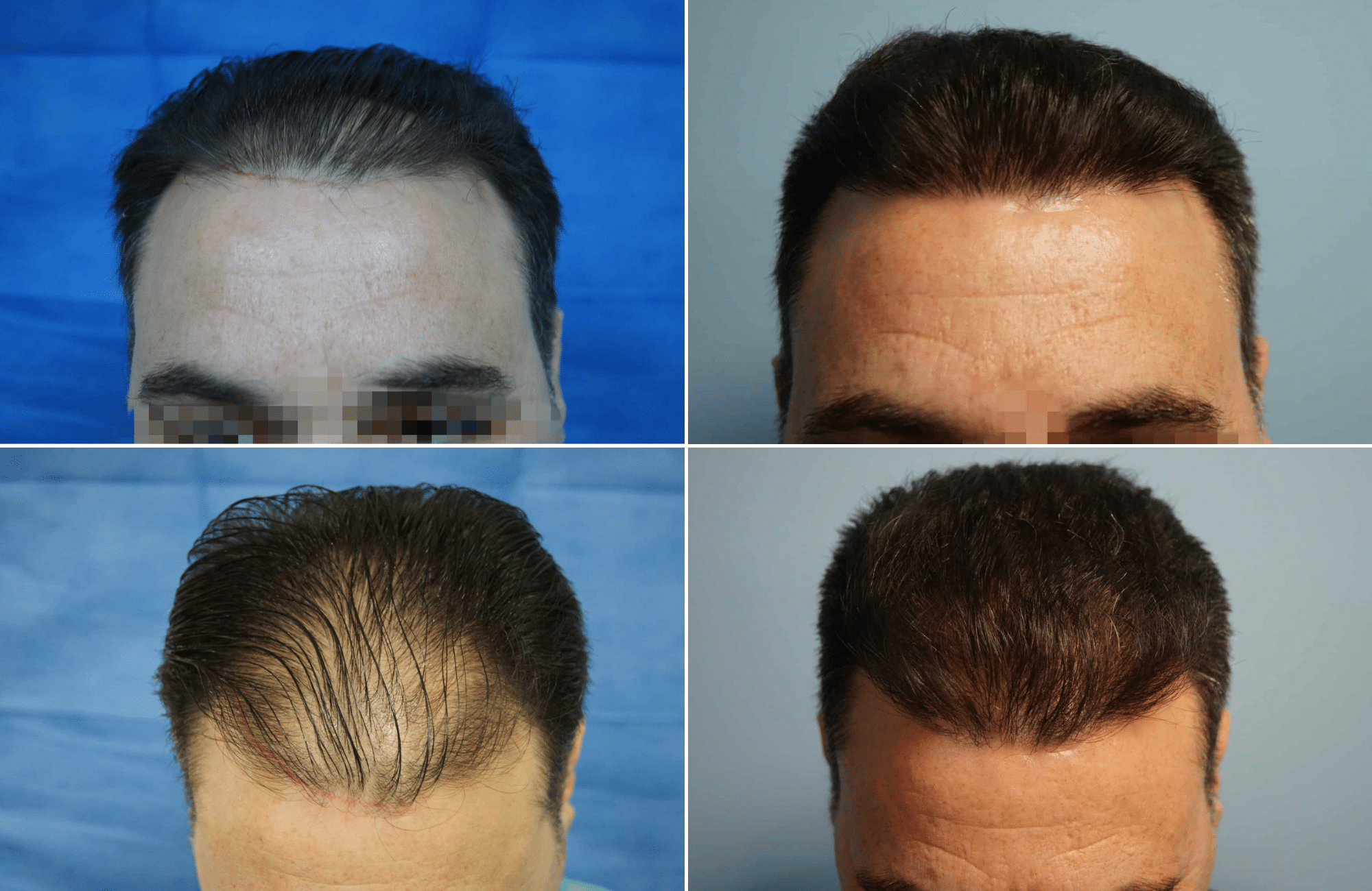 https://www.anastasakishairclinic.gr/portfolio/apotelesma-metamosxefsis-mallion-anastasakis-hair-clinic-60/