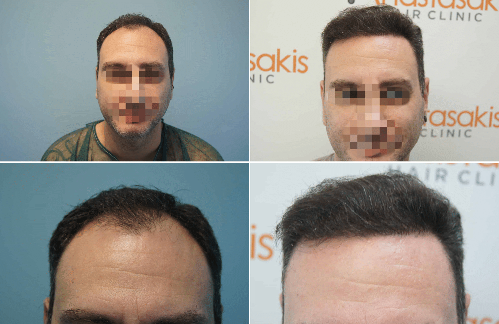https://www.anastasakishairclinic.gr/portfolio/apotelesma-metamosxefsis-mallion-anastasakis-hair-clinic-65/