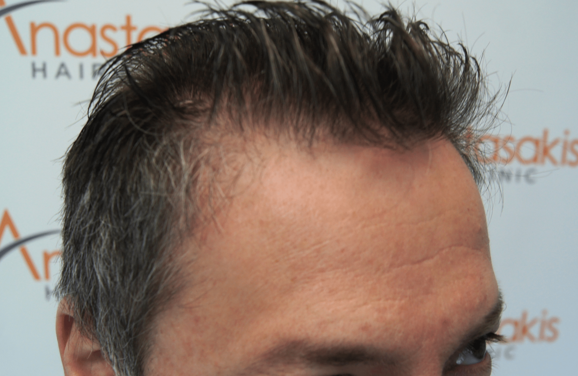 hair transplant result