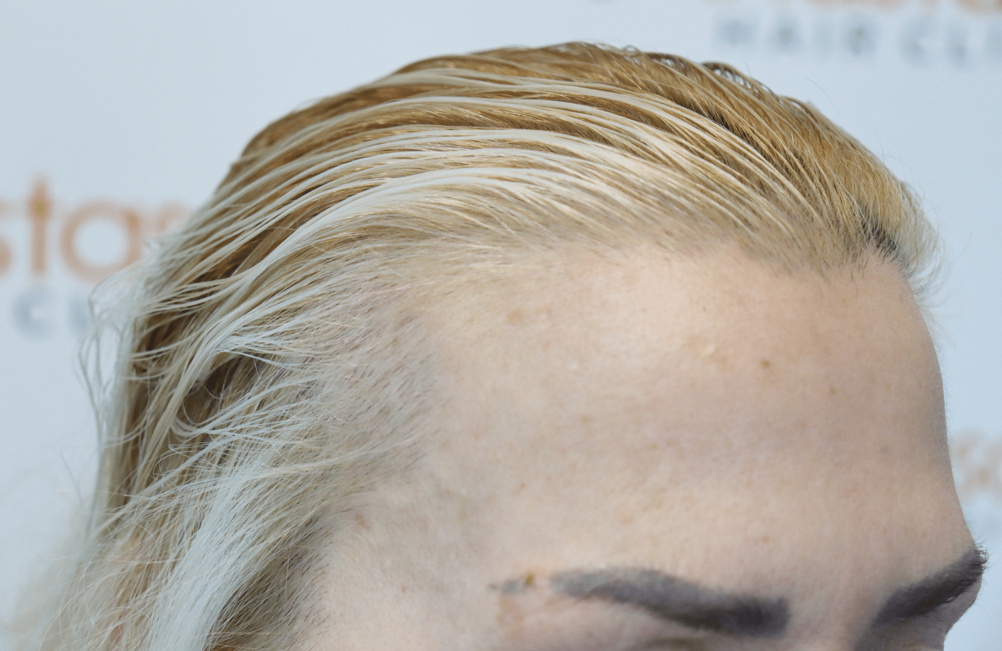 hair transplant result