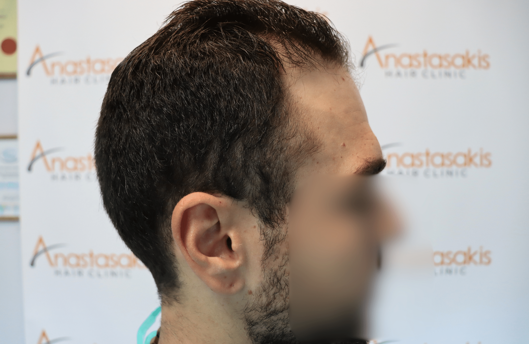 hair transplant result