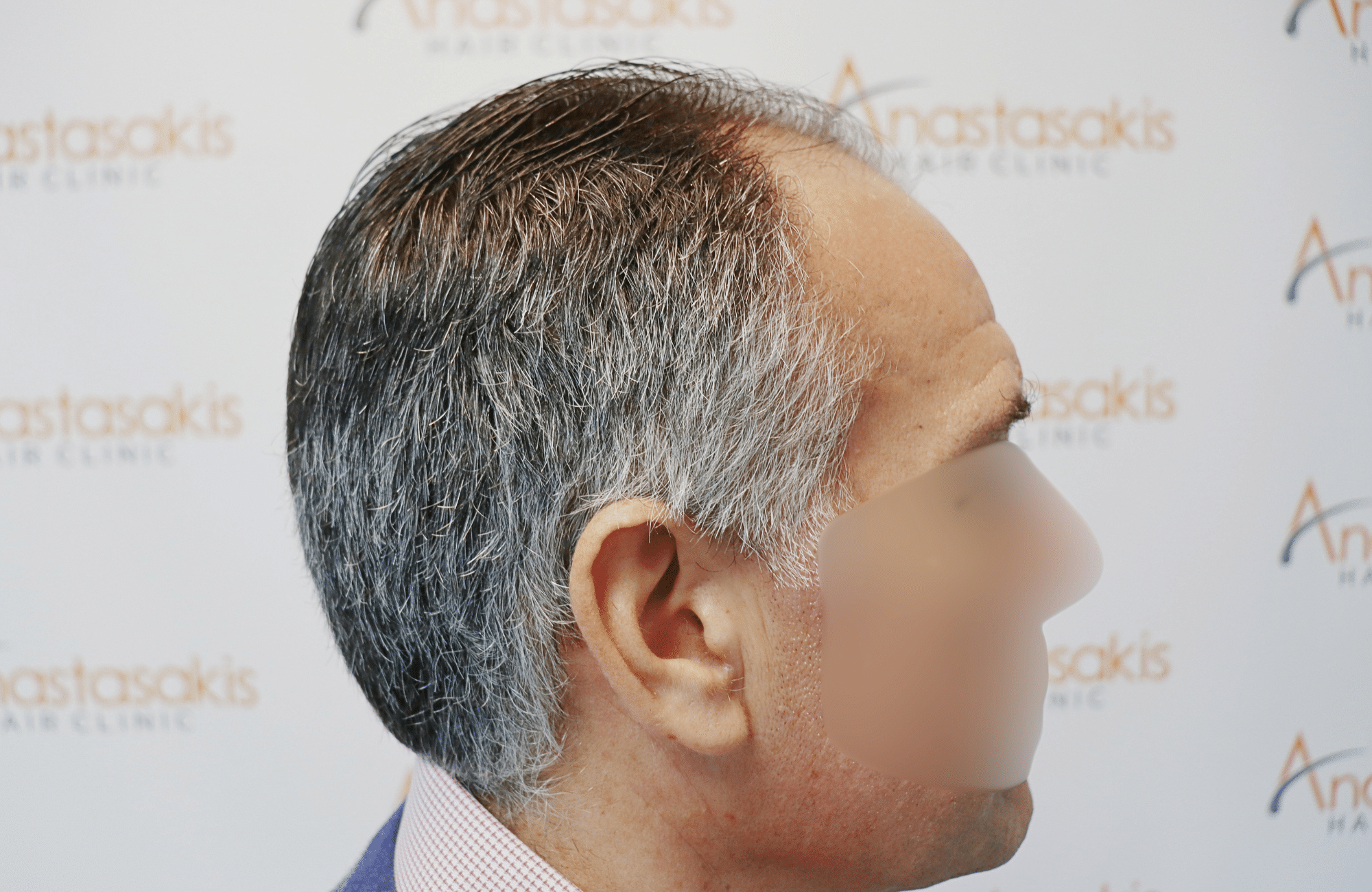 hair transplant result 2600