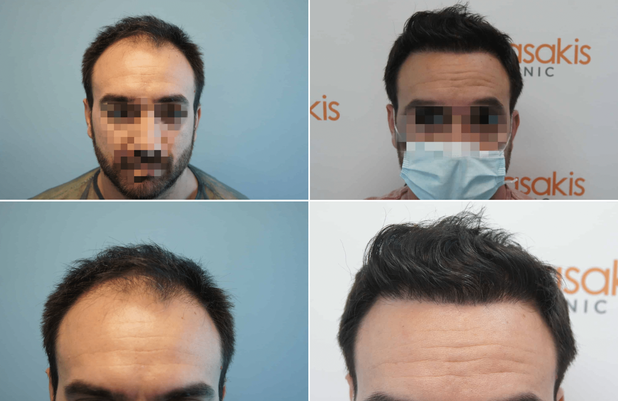 https://www.anastasakishairclinic.gr/portfolio/apotelesma-metamosxefsis-mallion-anastasakis-hair-clinic-72/