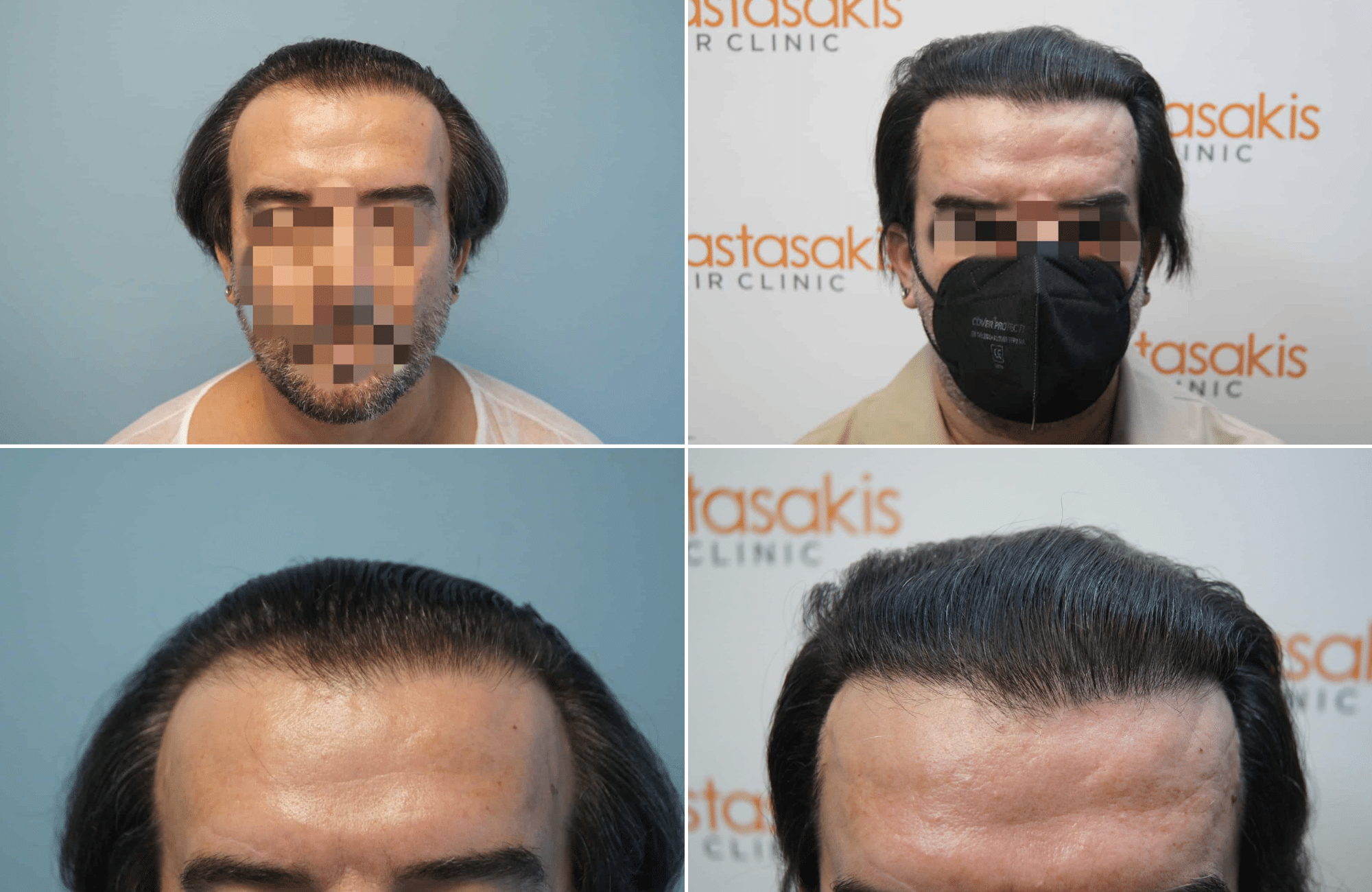 https://www.anastasakishairclinic.gr/portfolio/apotelesma-metamosxefsis-mallion-anastasakis-hair-clinic-73/