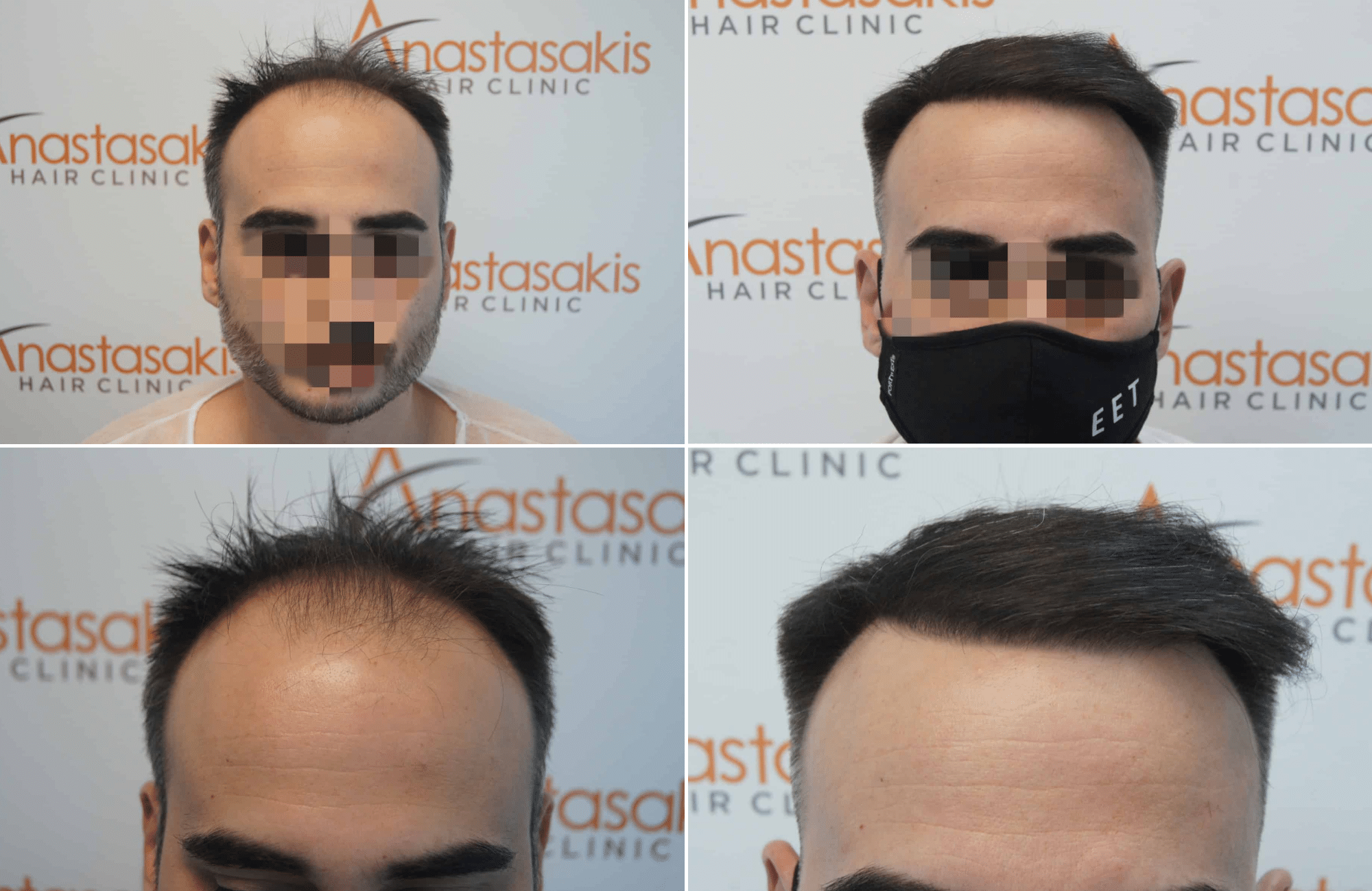 https://www.anastasakishairclinic.gr/portfolio/apotelesma-metamosxefsis-mallion-anastasakis-hair-clinic-75/