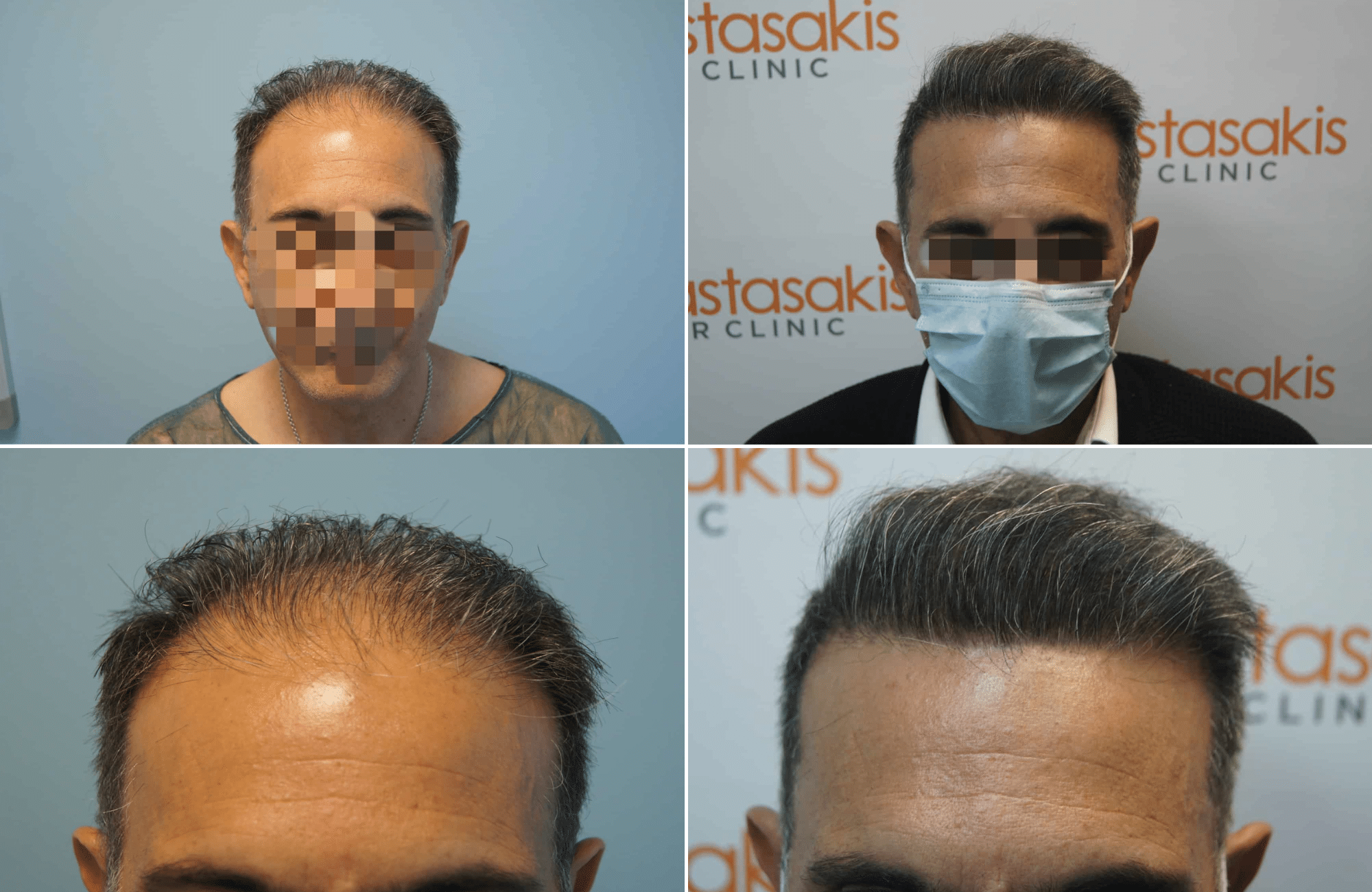 https://www.anastasakishairclinic.gr/portfolio/apotelesma-metamosxefsis-mallion-anastasakis-hair-clinic-77/