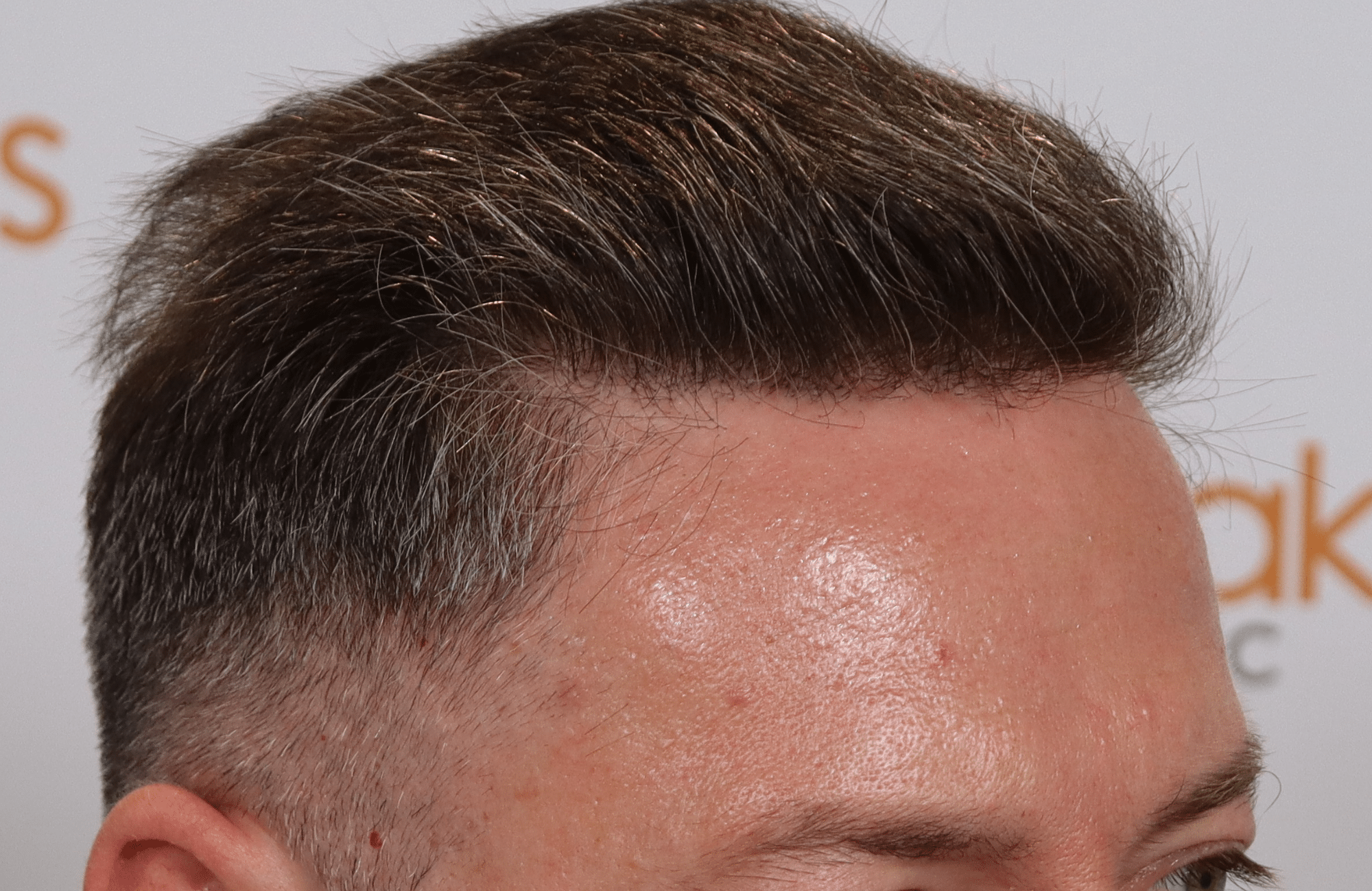 hair transplant result