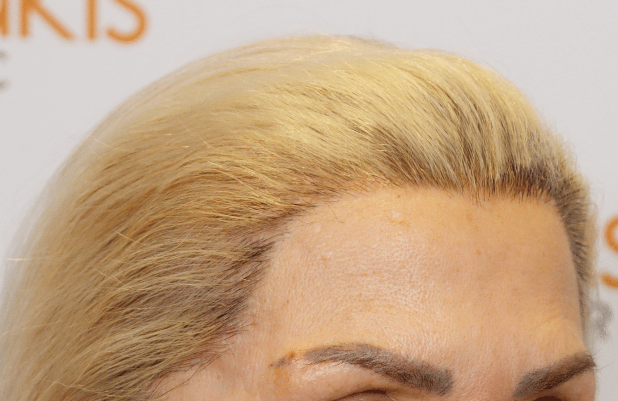 hair transplant result
