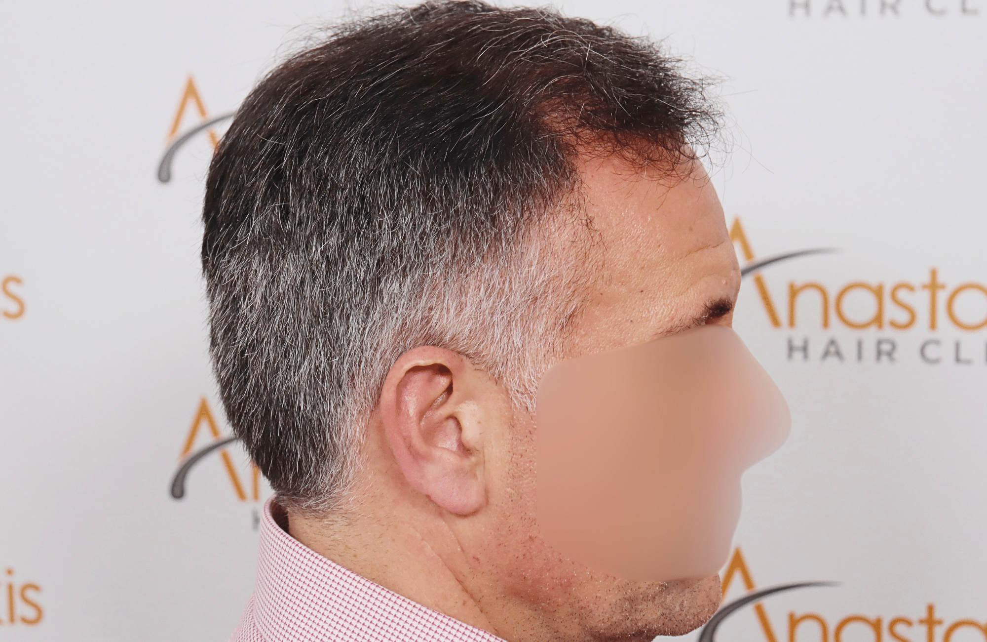 hair transplant result 2600