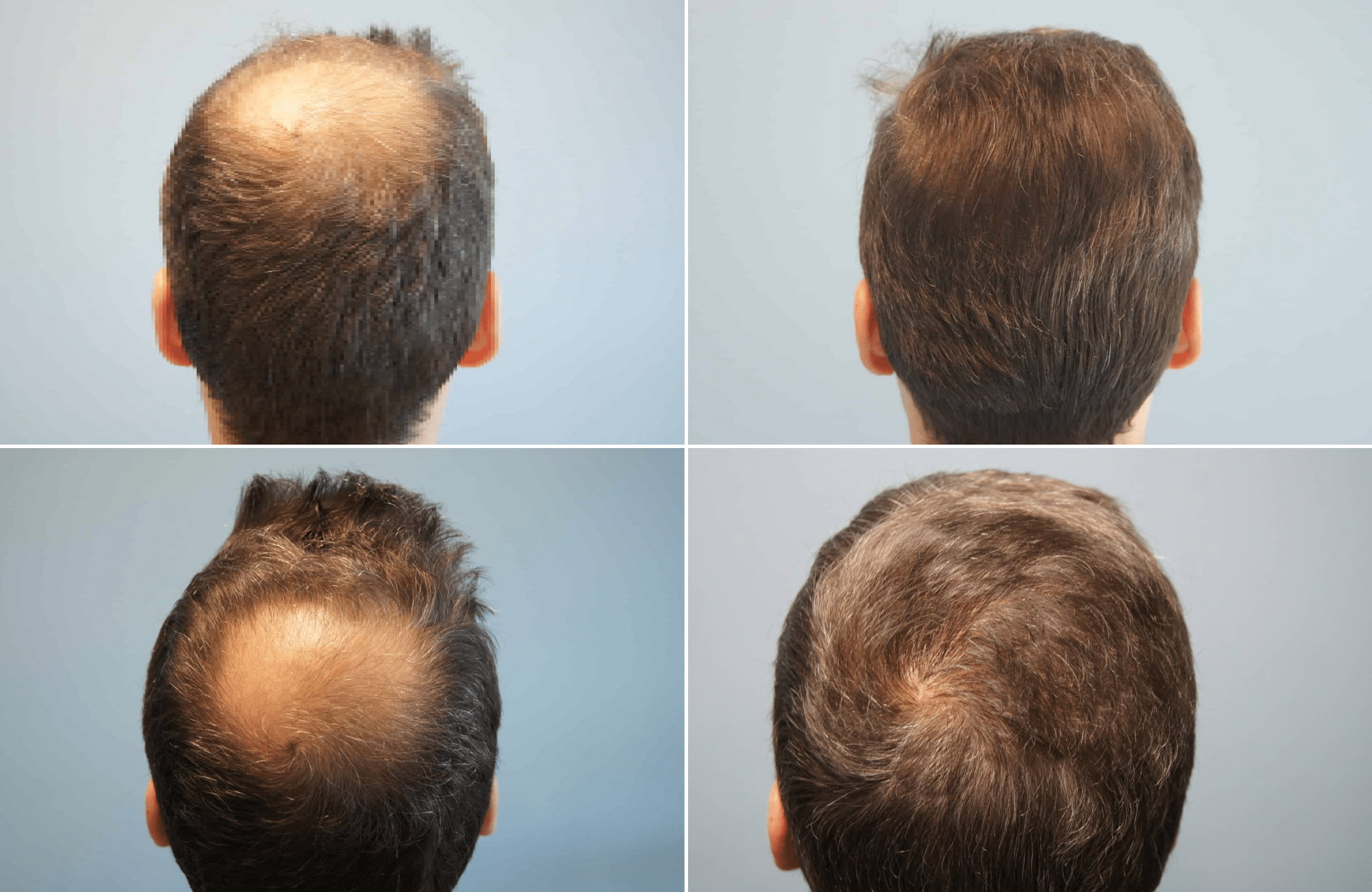 https://www.anastasakishairclinic.gr/portfolio/apotelesma-metamosxefsis-mallion-anastasakis-hair-clinic-81/