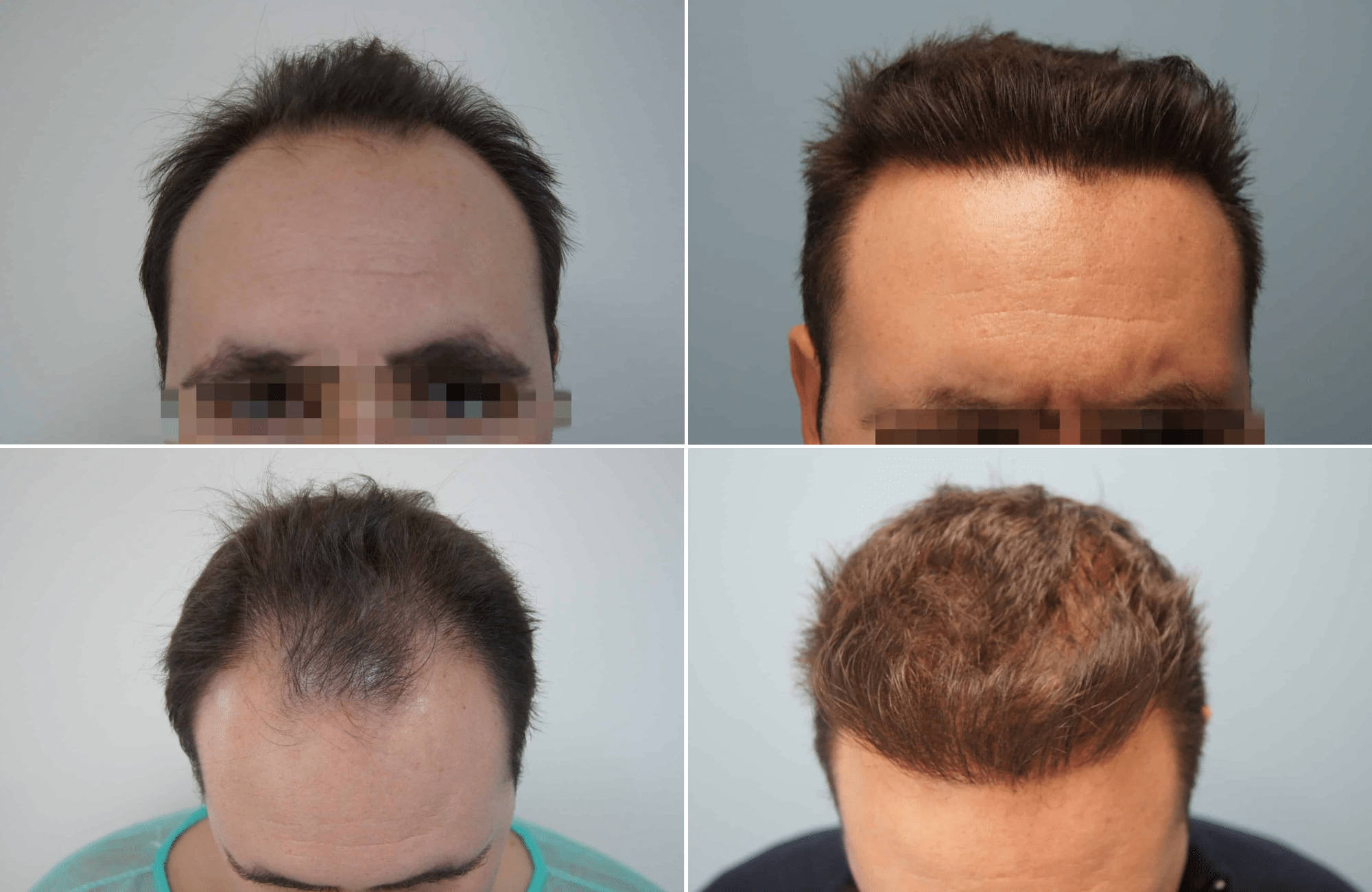 https://www.anastasakishairclinic.gr/portfolio/apotelesma-metamosxefsis-mallion-anastasakis-hair-clinic-82/