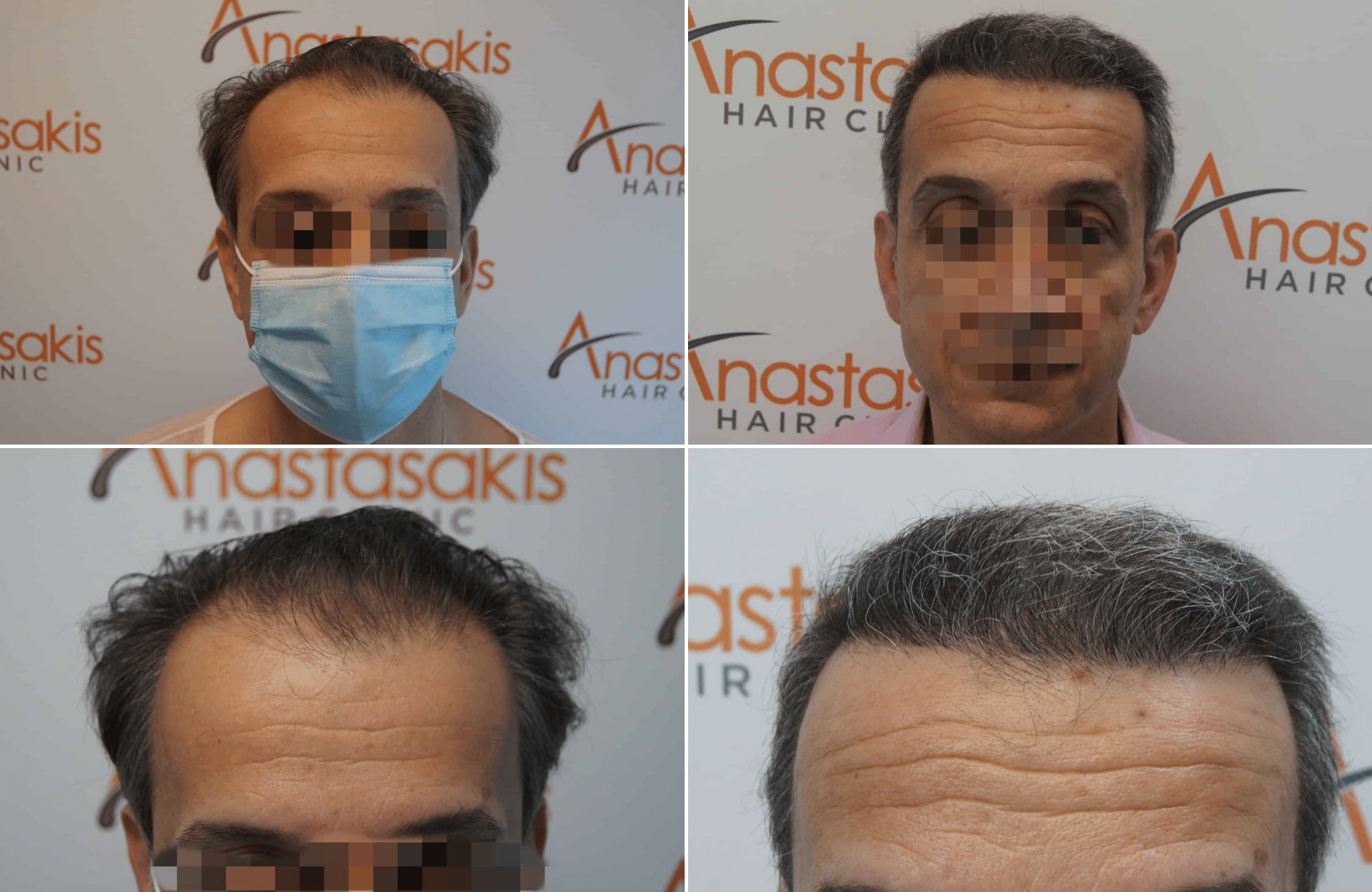 https://www.anastasakishairclinic.gr/portfolio/apotelesma-metamosxefsis-mallion-anastasakis-hair-clinic-84/