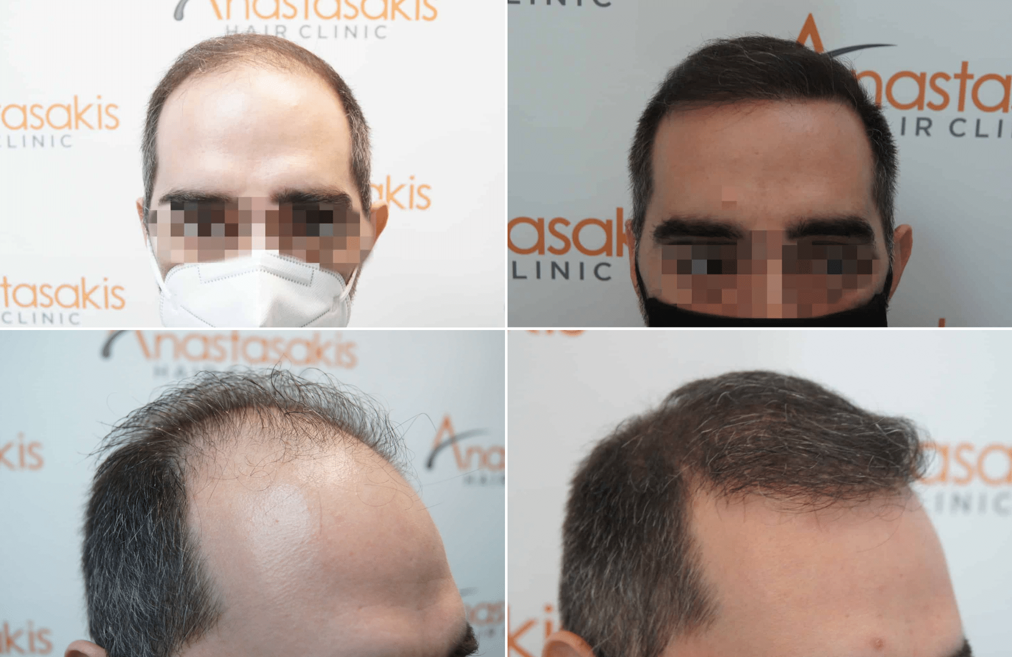 https://www.anastasakishairclinic.gr/portfolio/apotelesma-metamosxefsis-mallion-anastasakis-hair-clinic-87/