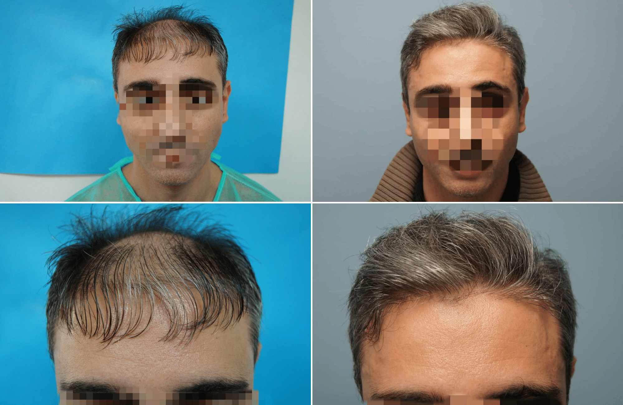 https://www.anastasakishairclinic.gr/portfolio/apotelesma-metamosxefsis-mallion-anastasakis-hair-clinic-89/